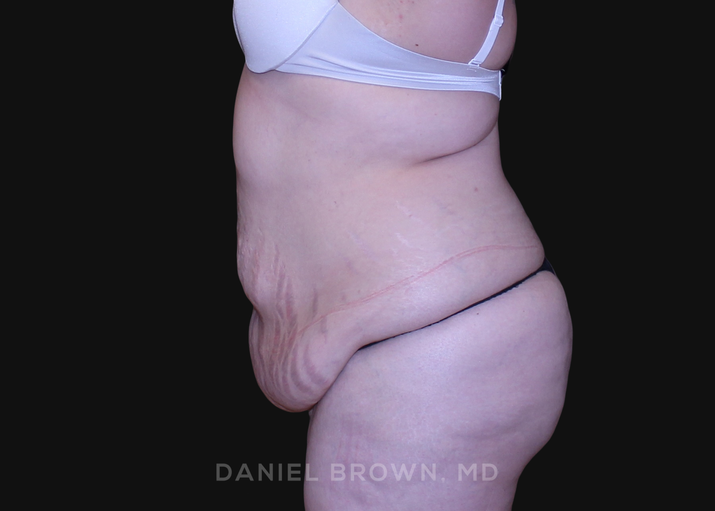 Tummy Tuck Patient Photo - Case 1112 - before view-3