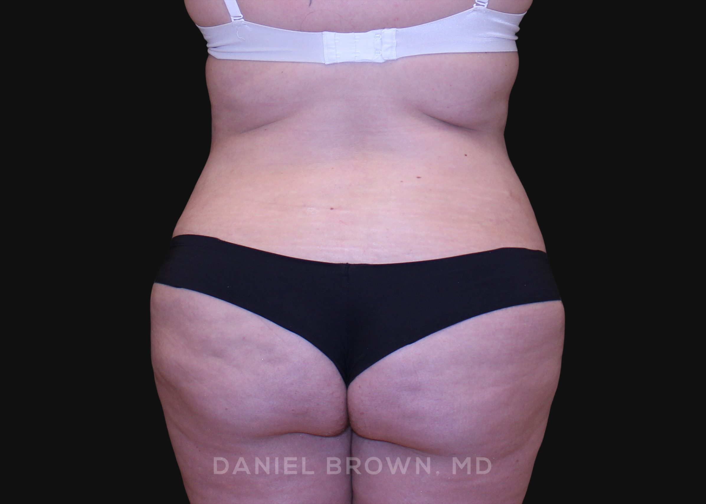 Tummy Tuck Patient Photo - Case 1112 - after view