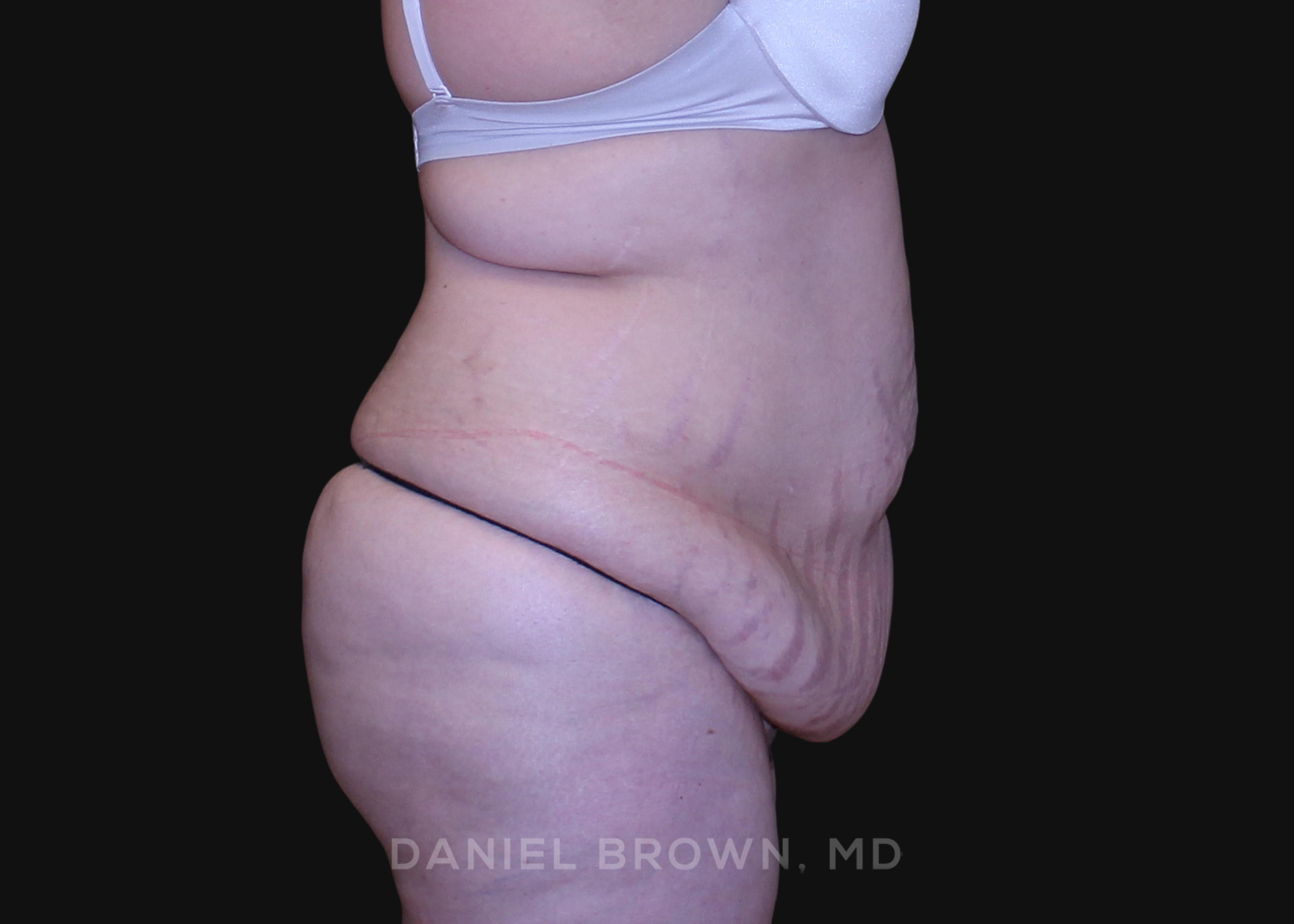 Tummy Tuck Patient Photo - Case 1112 - before view-4