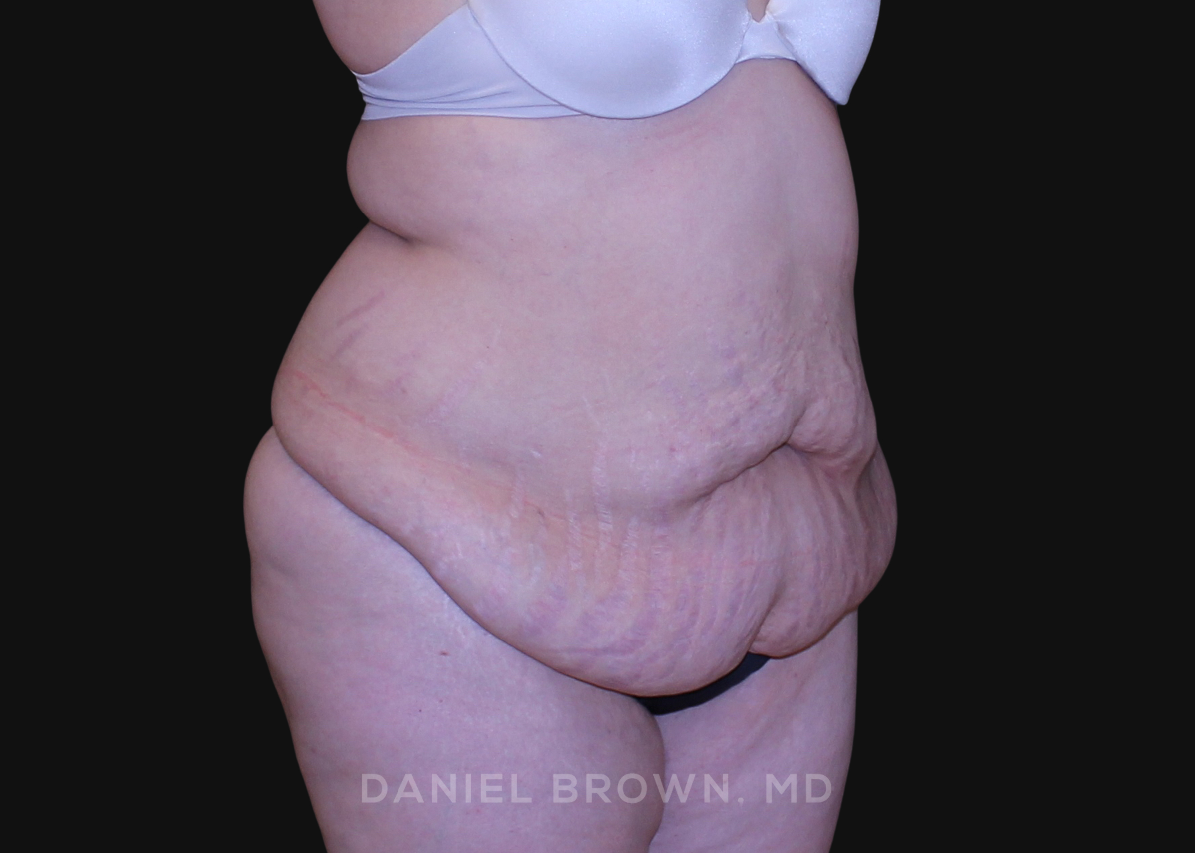 Tummy Tuck Patient Photo - Case 1112 - before view-2