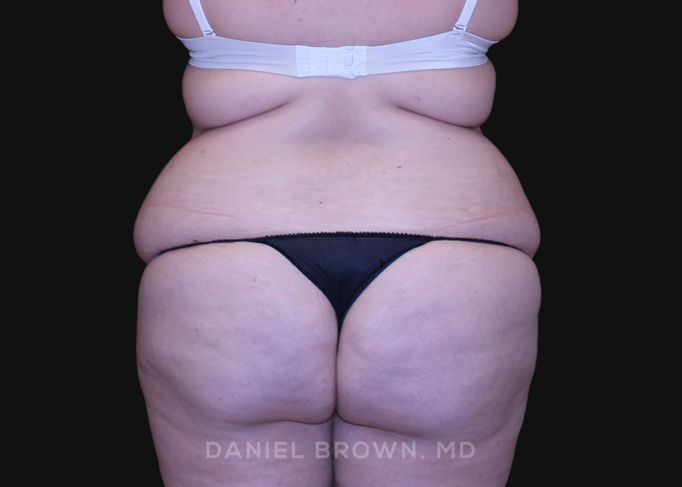 Tummy Tuck Patient Photo - Case 1112 - before view-5