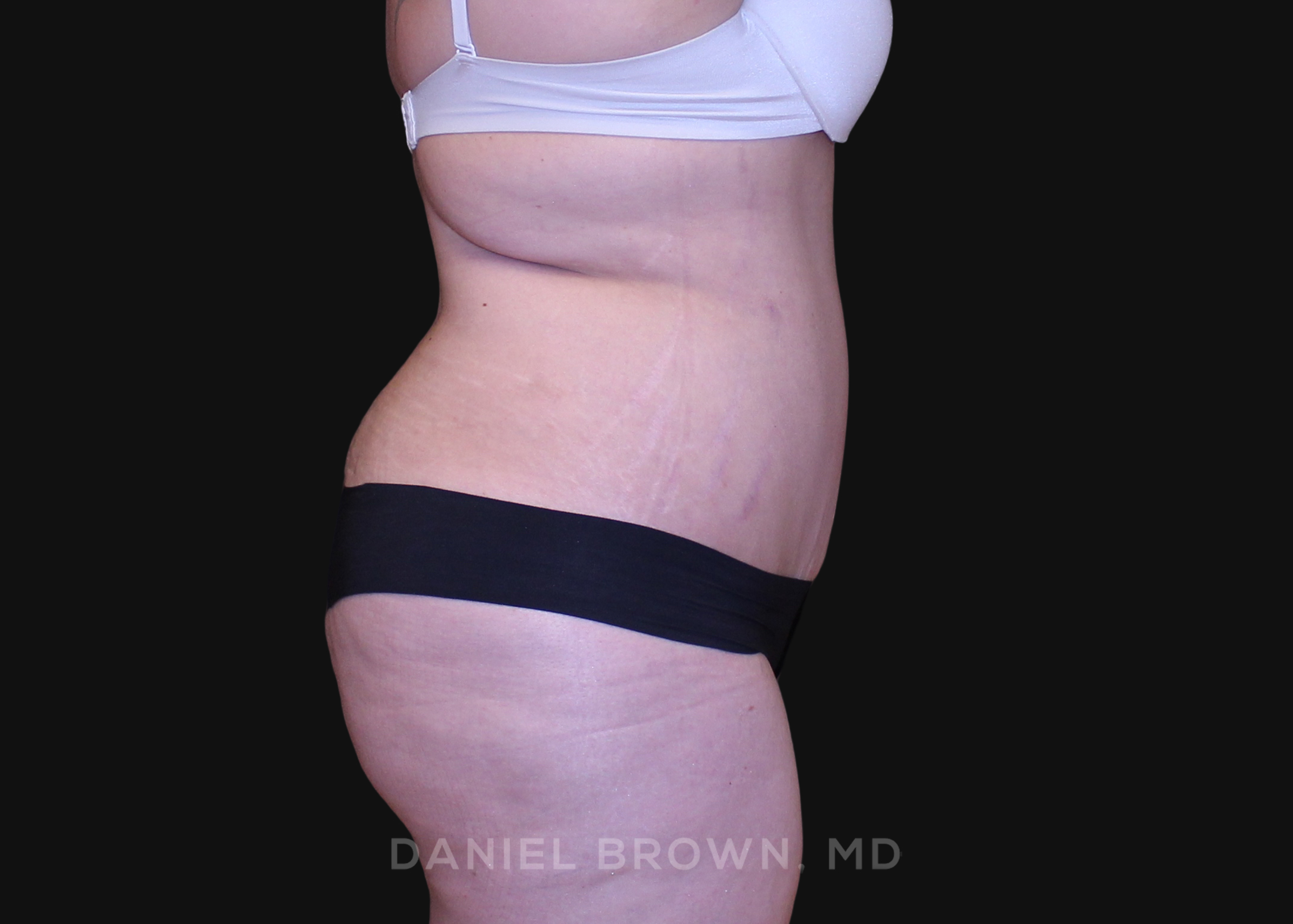 Tummy Tuck Patient Photo - Case 1112 - after view-4