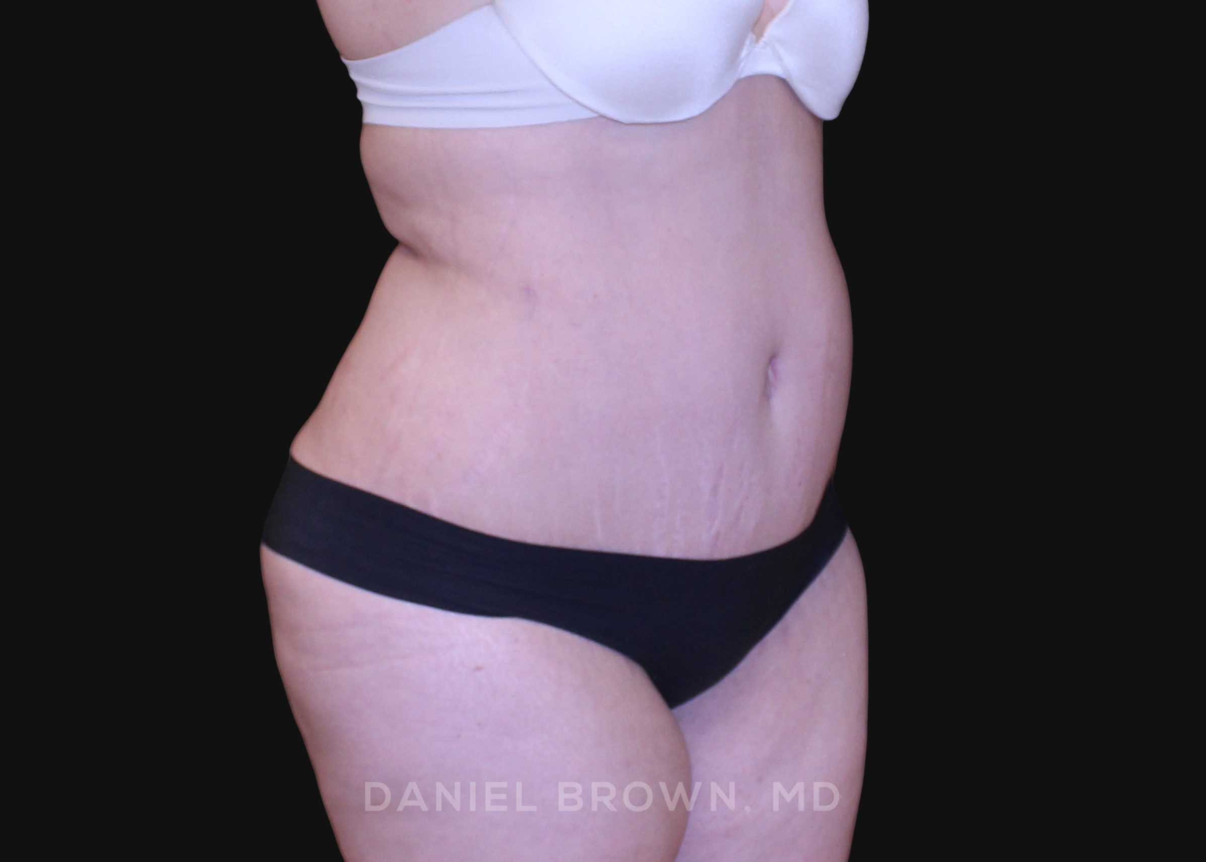 Tummy Tuck Patient Photo - Case 1112 - after view-2