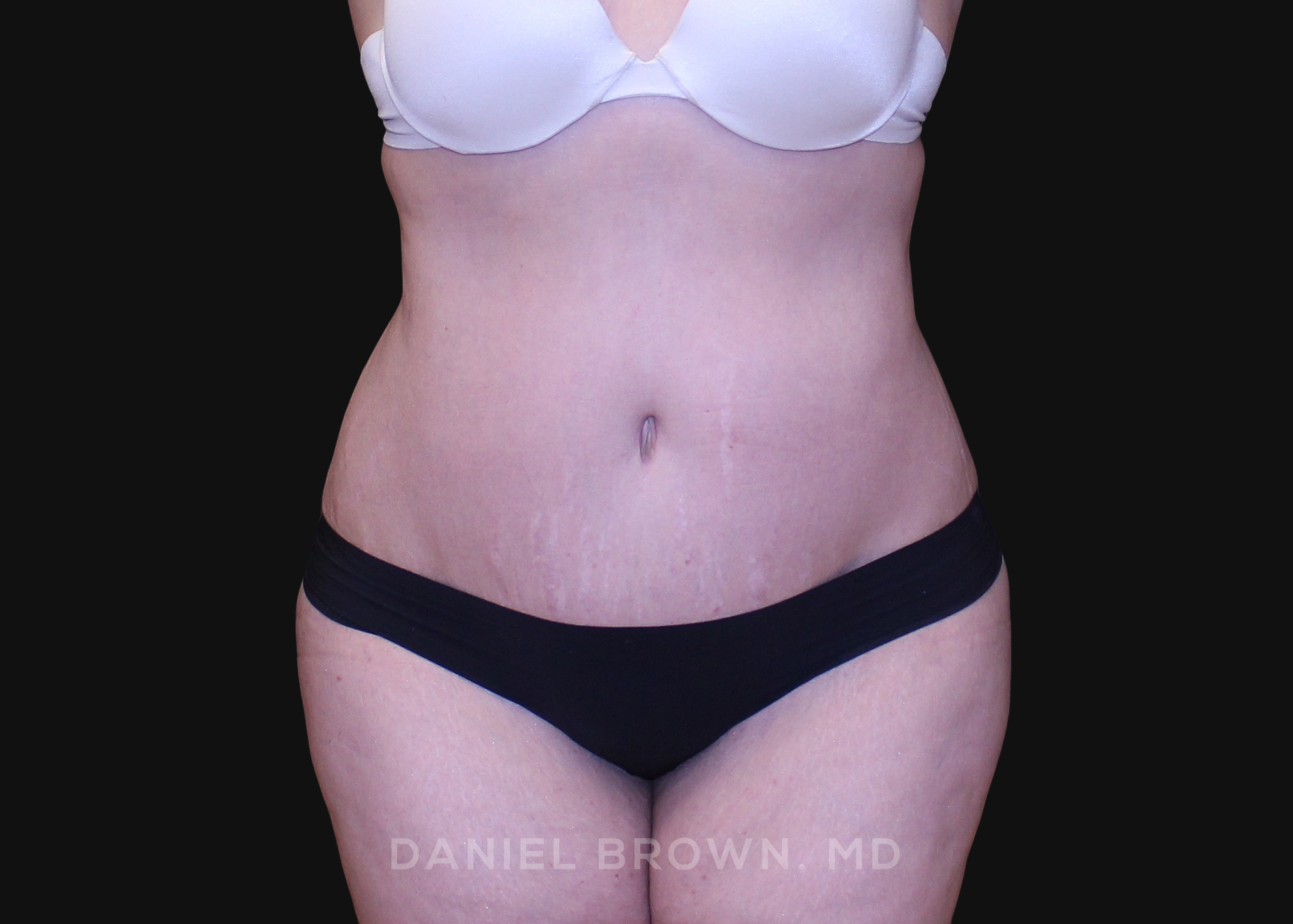 Tummy Tuck Patient Photo - Case 1112 - after view