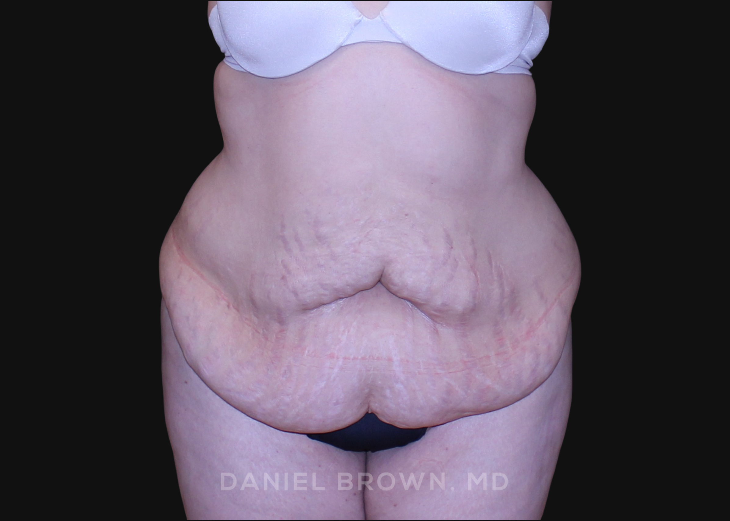 Tummy Tuck Patient Photo - Case 1112 - before view-0