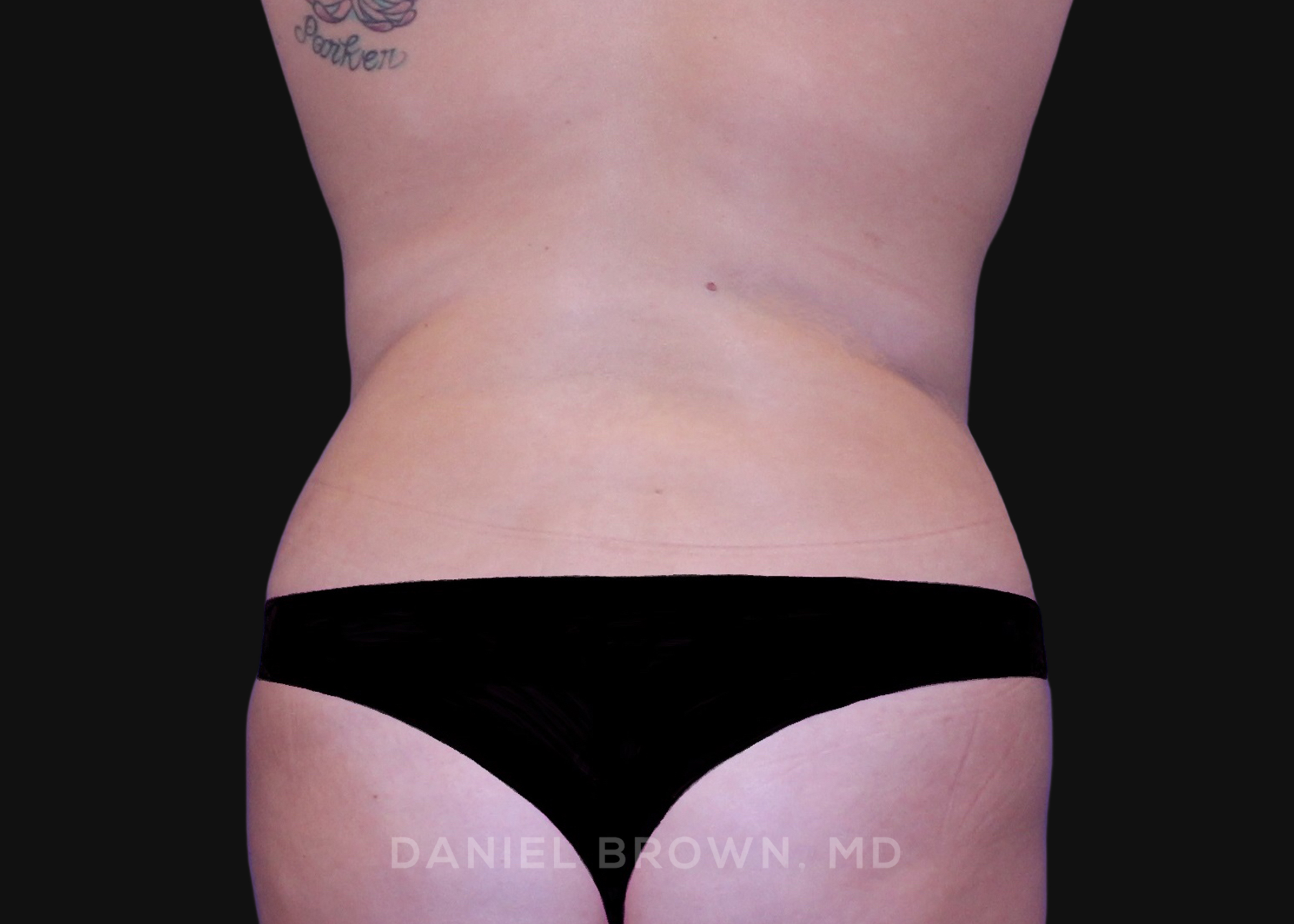 Tummy Tuck Patient Photo - Case 1125 - after view