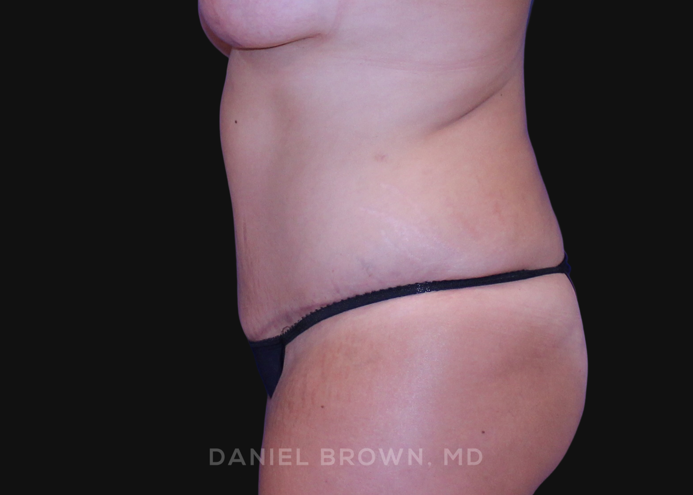 Tummy Tuck Patient Photo - Case 1125 - after view