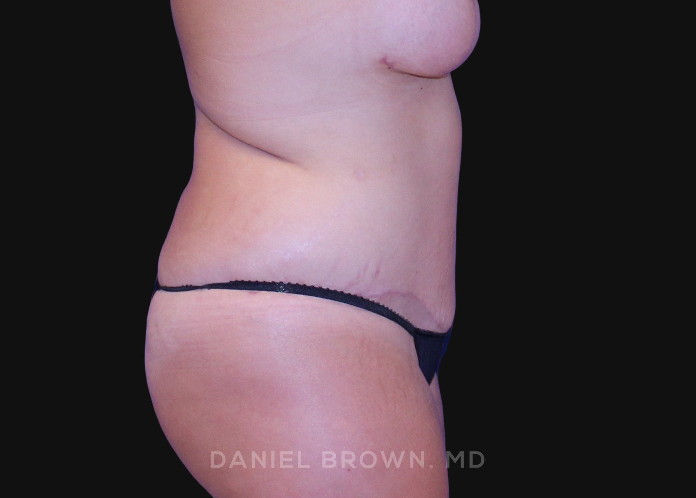 Tummy Tuck Patient Photo - Case 1125 - after view-4