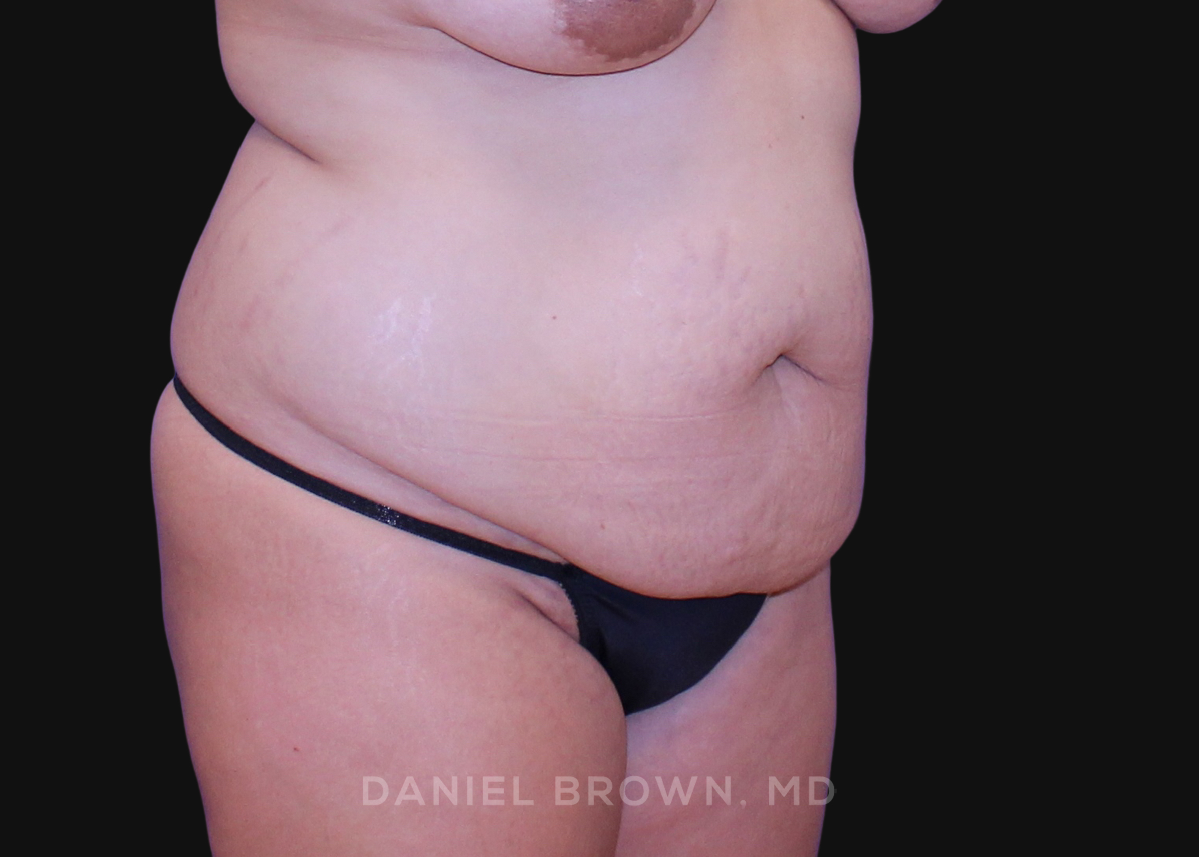Tummy Tuck Patient Photo - Case 1125 - before view-2