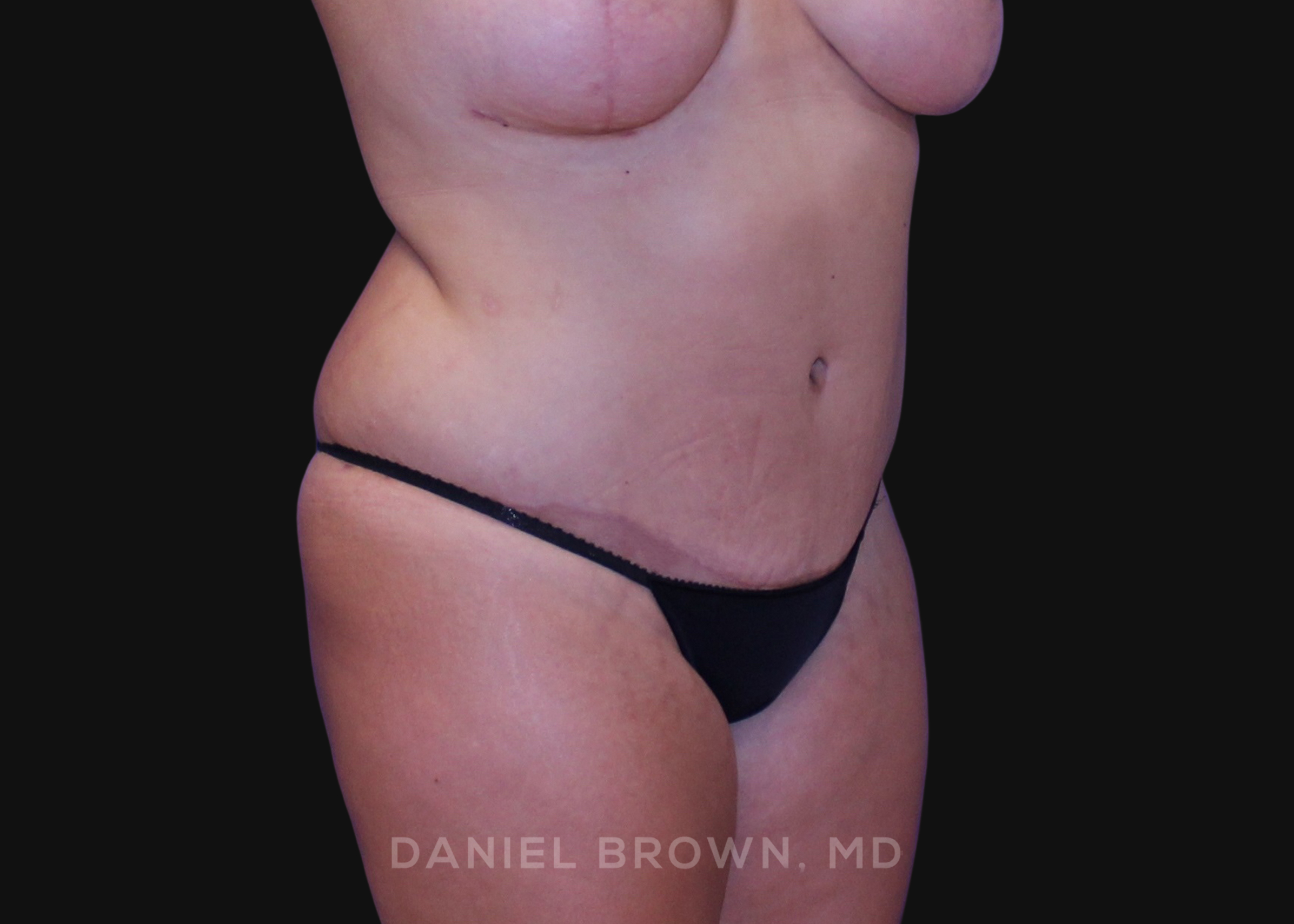 Tummy Tuck Patient Photo - Case 1125 - after view-2