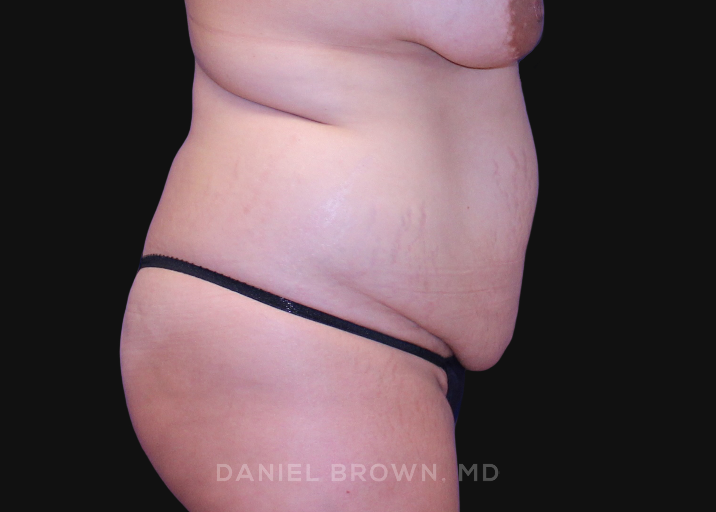 Tummy Tuck Patient Photo - Case 1125 - before view-4