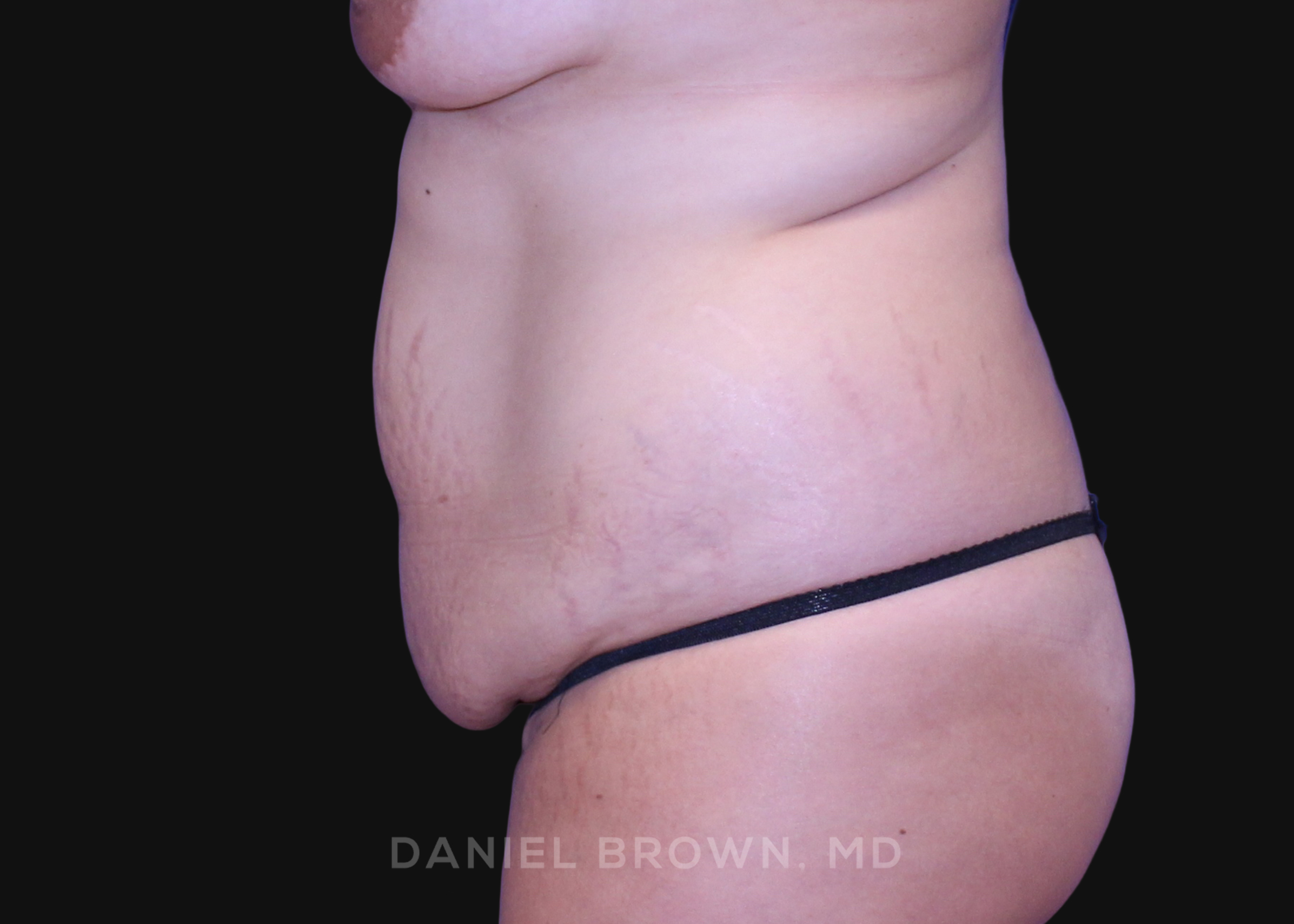 Tummy Tuck Patient Photo - Case 1125 - before view-