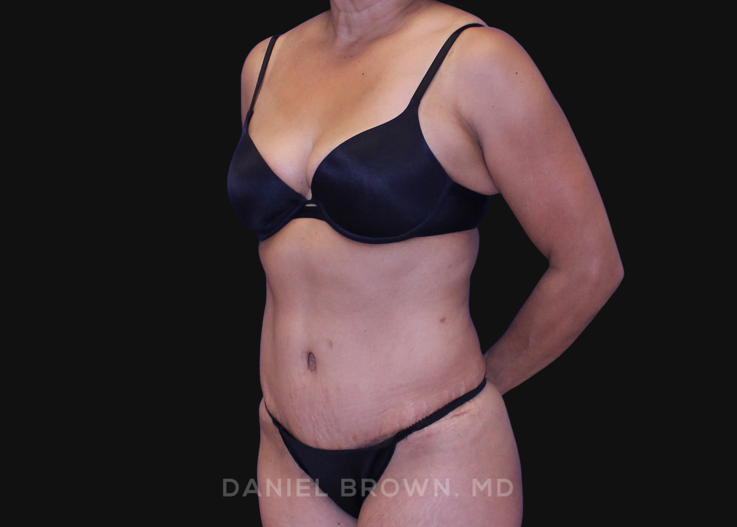 Tummy Tuck Patient Photo - Case 1138 - after view-1