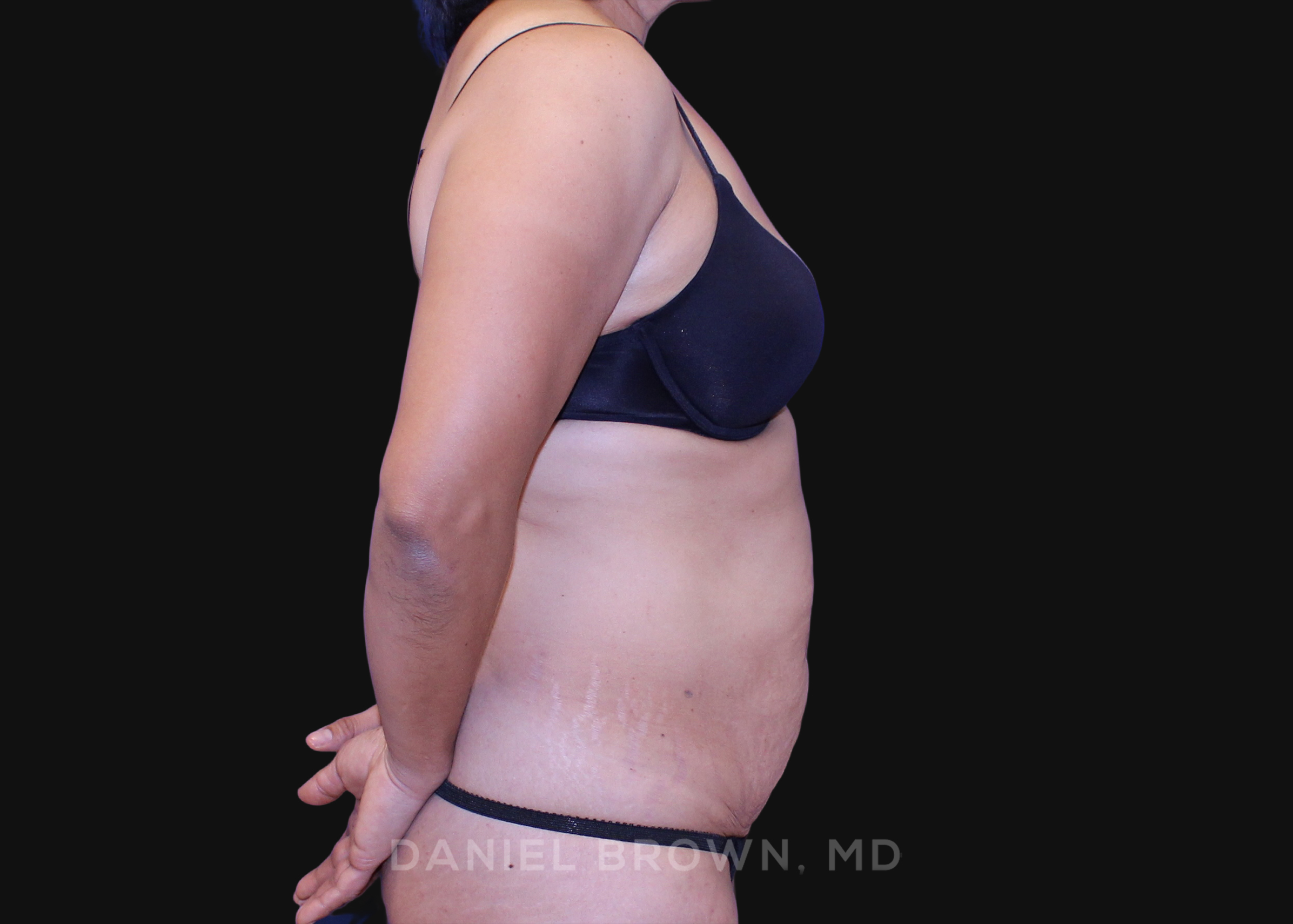 Tummy Tuck Patient Photo - Case 1138 - before view-