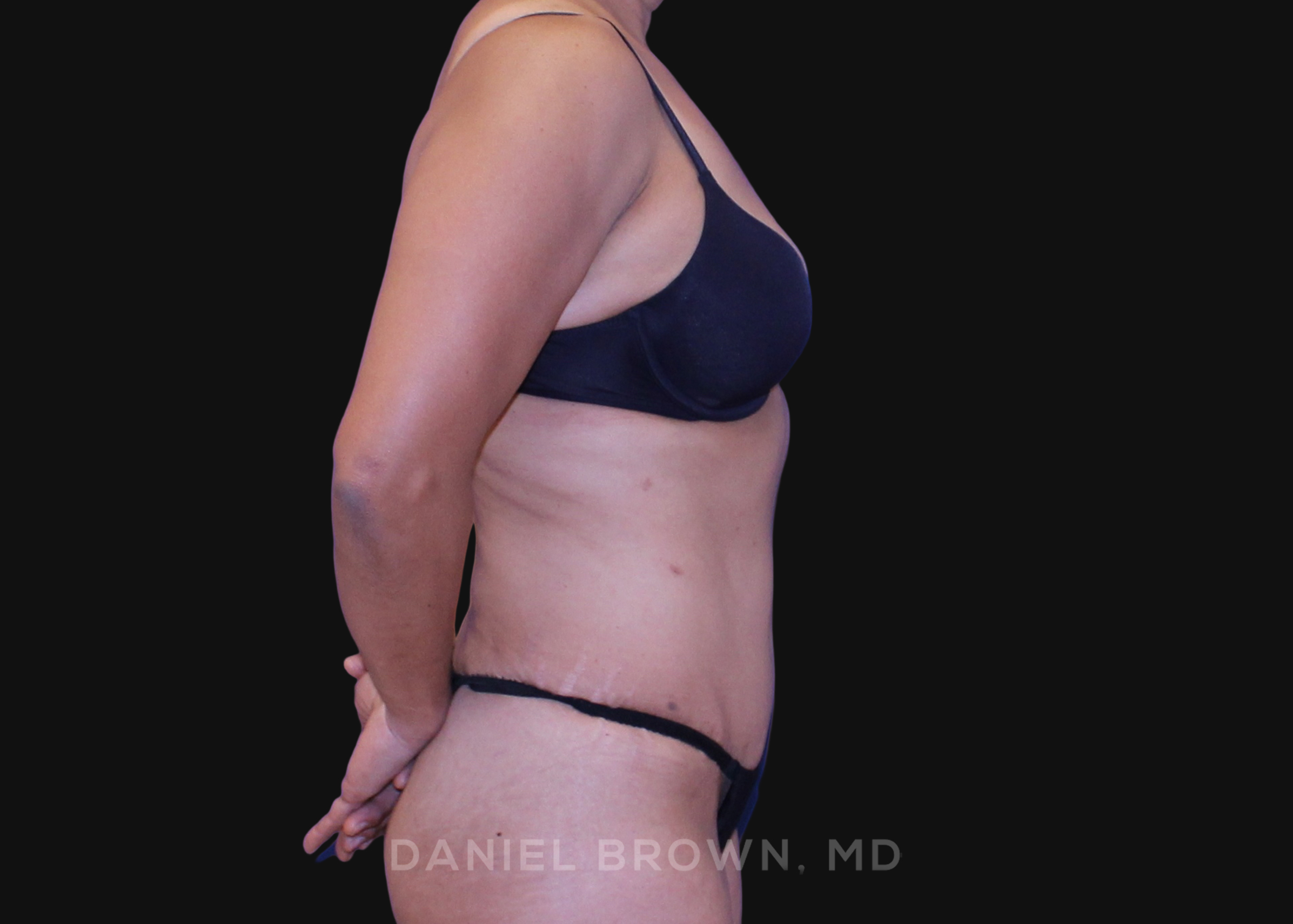 Tummy Tuck Patient Photo - Case 1138 - after view-4