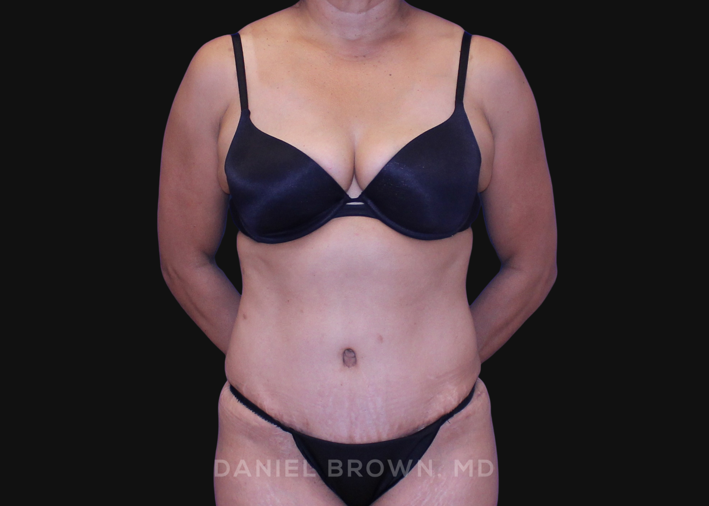Tummy Tuck Patient Photo - Case 1138 - after view-0