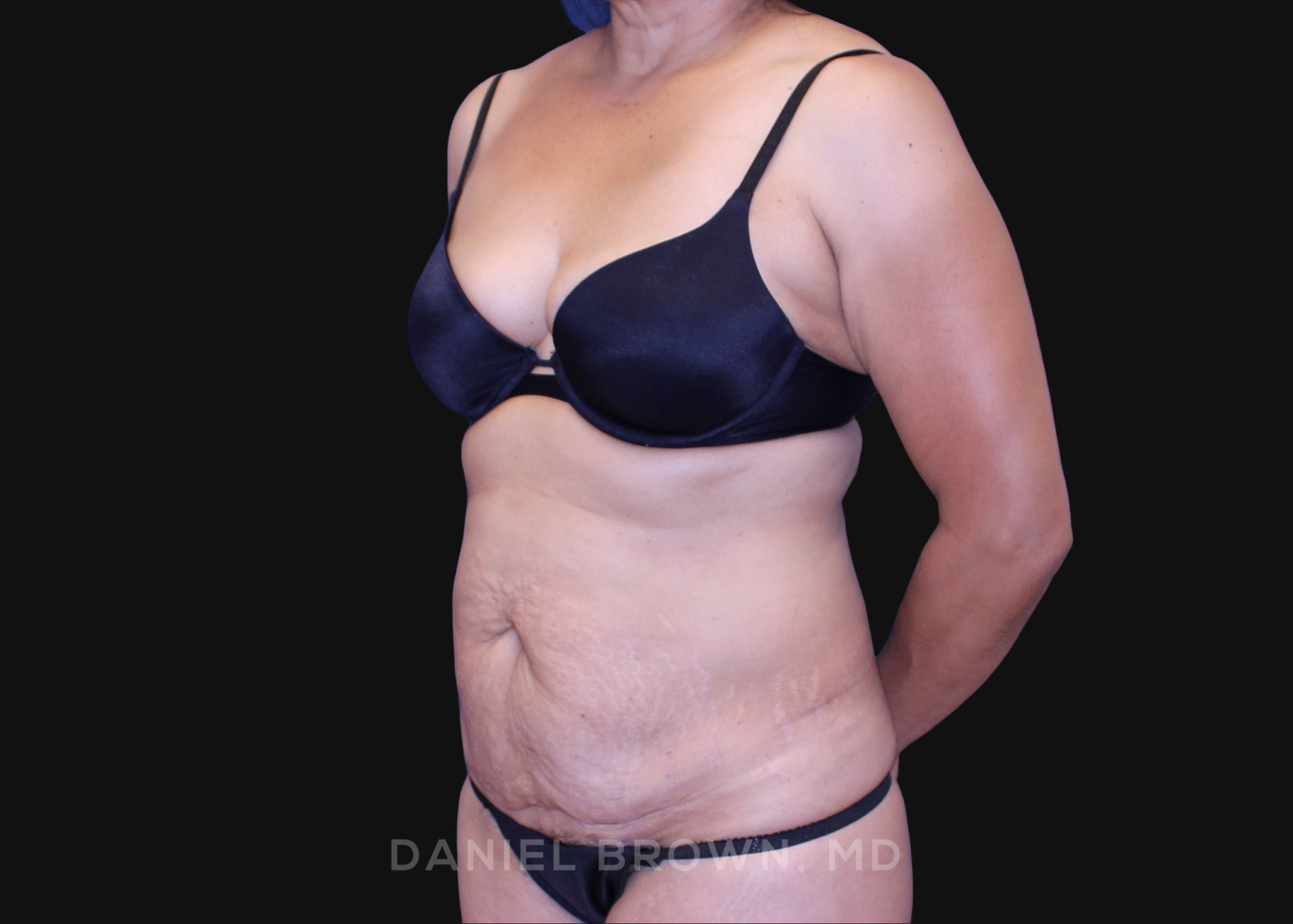 Tummy Tuck Patient Photo - Case 1138 - before view-