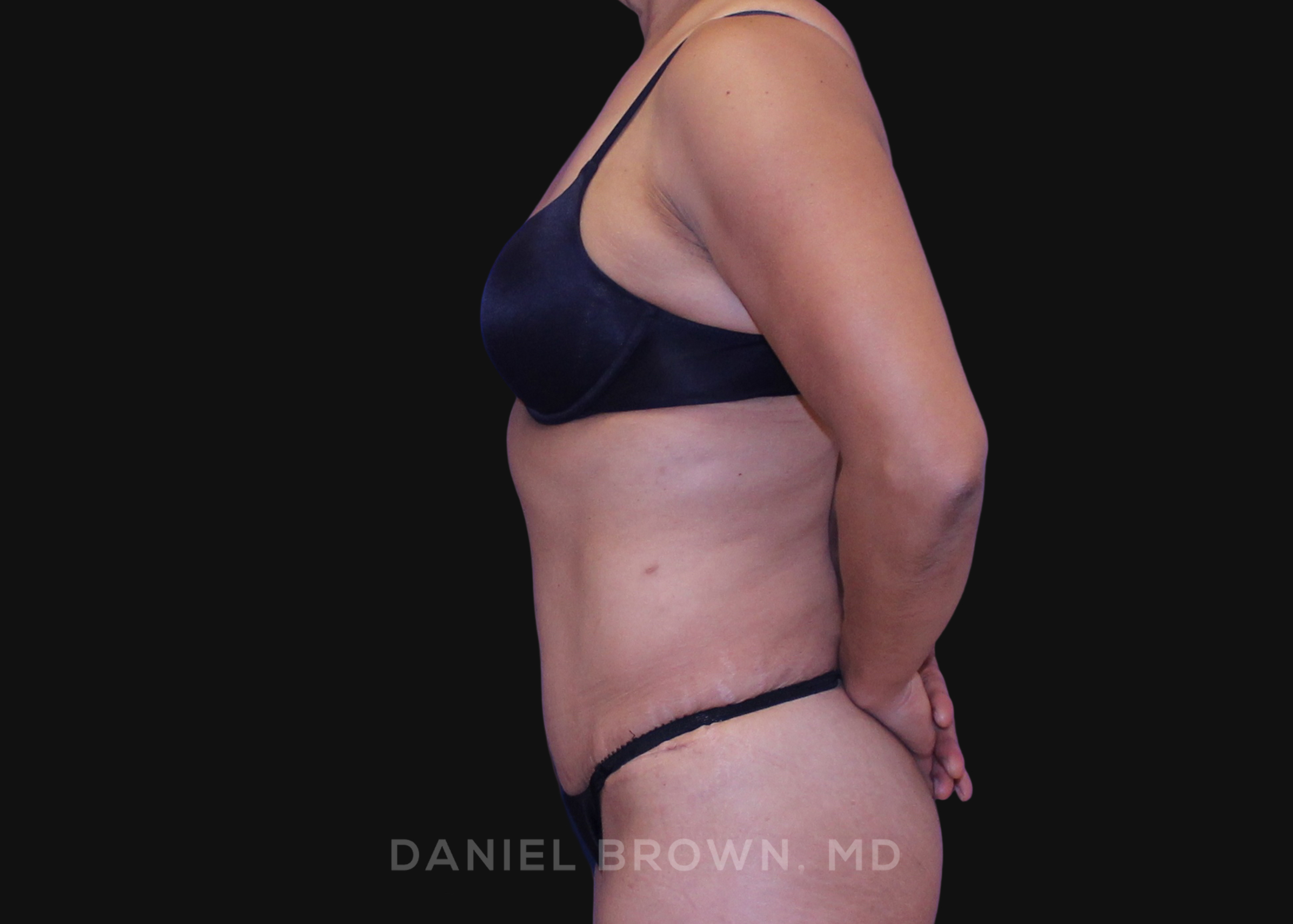 Tummy Tuck Patient Photo - Case 1138 - after view-3