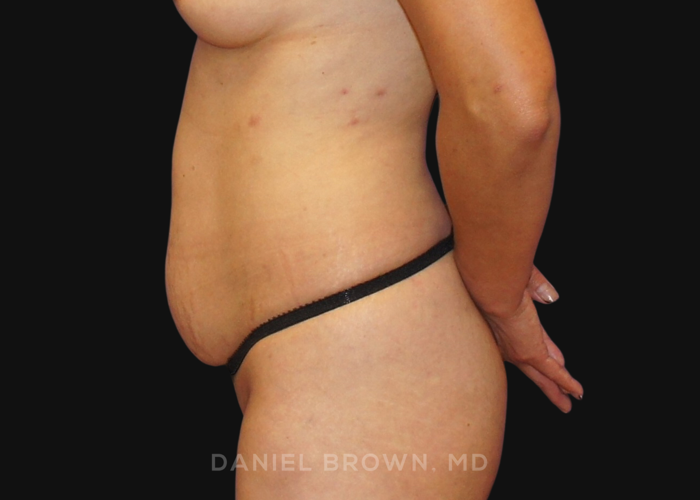 Tummy Tuck Patient Photo - Case 1149 - before view-