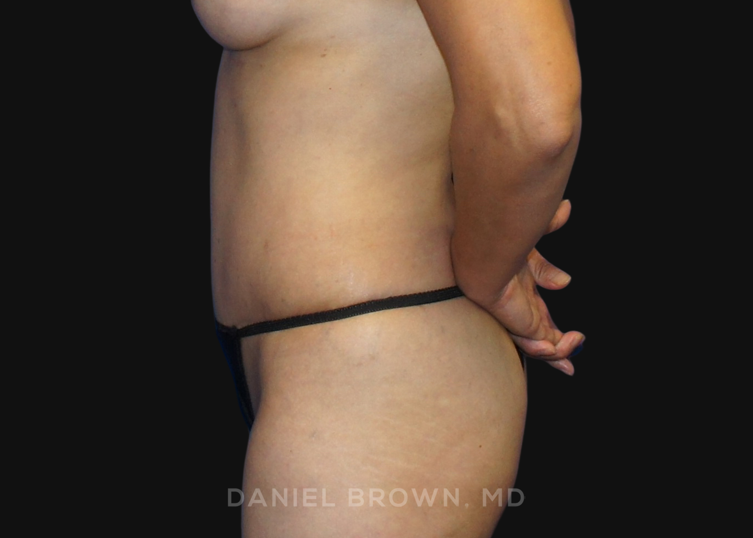 Tummy Tuck Patient Photo - Case 1149 - after view