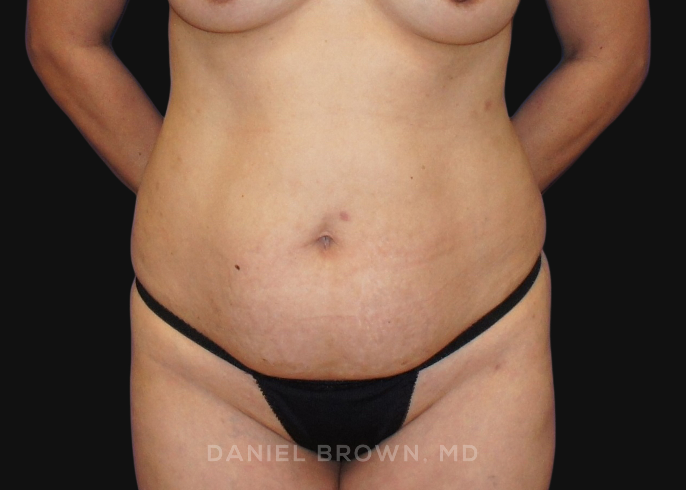 Tummy Tuck Patient Photo - Case 1149 - before view-