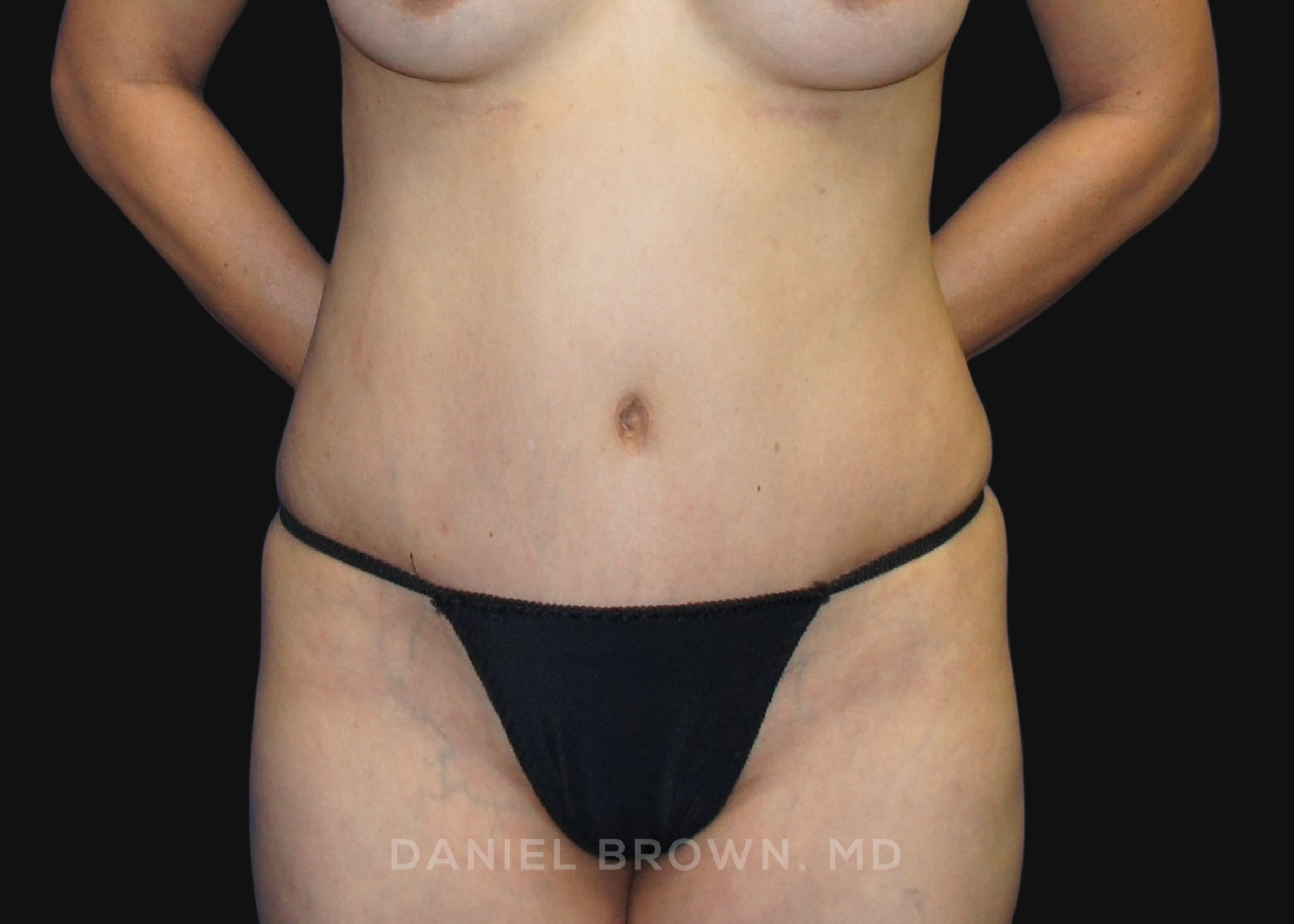 Tummy Tuck Patient Photo - Case 1149 - after view