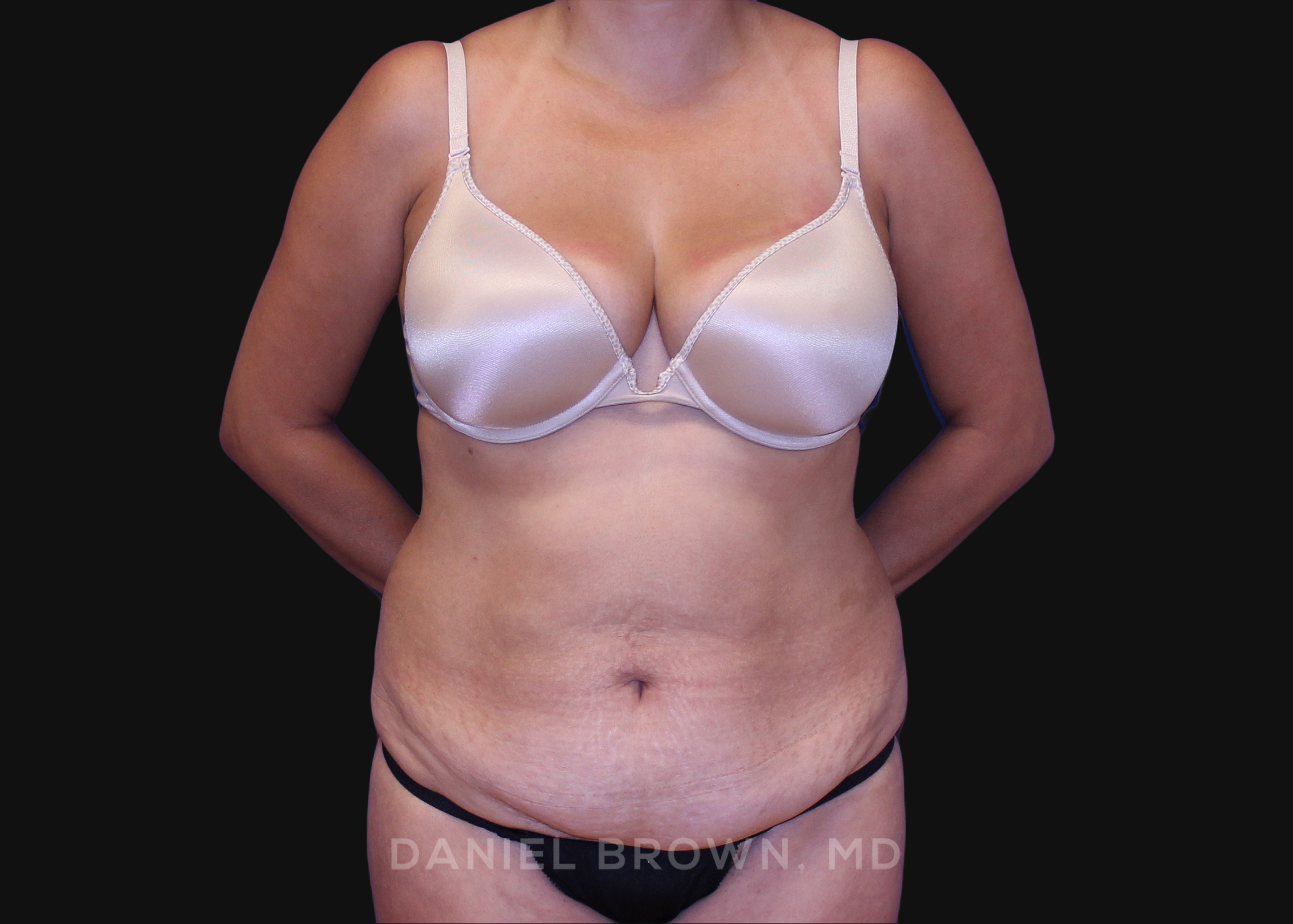 Tummy Tuck Patient Photo - Case 1163 - before view-0