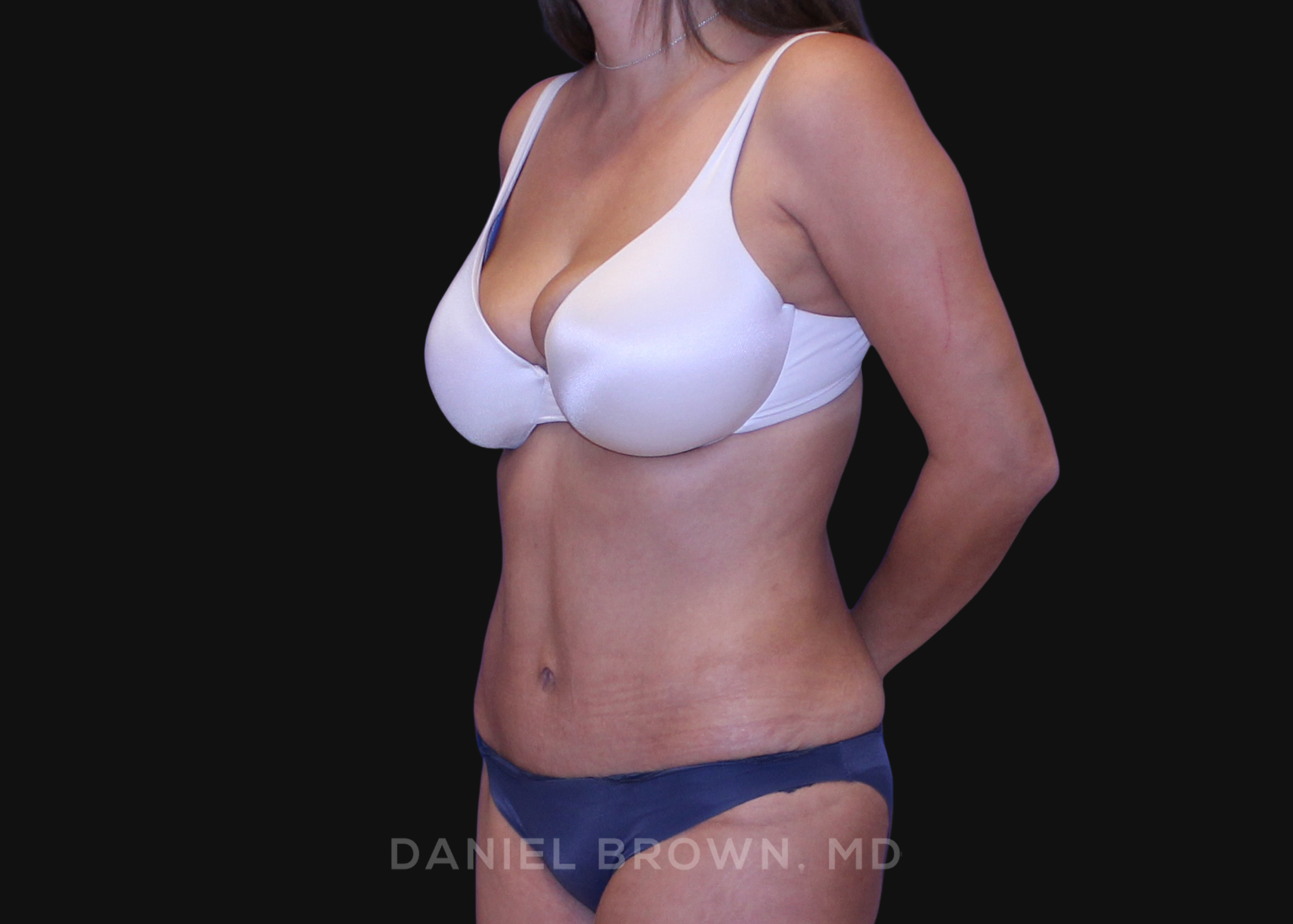 Tummy Tuck Patient Photo - Case 1163 - after view