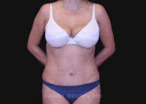 Tummy Tuck - Case 1163 - After