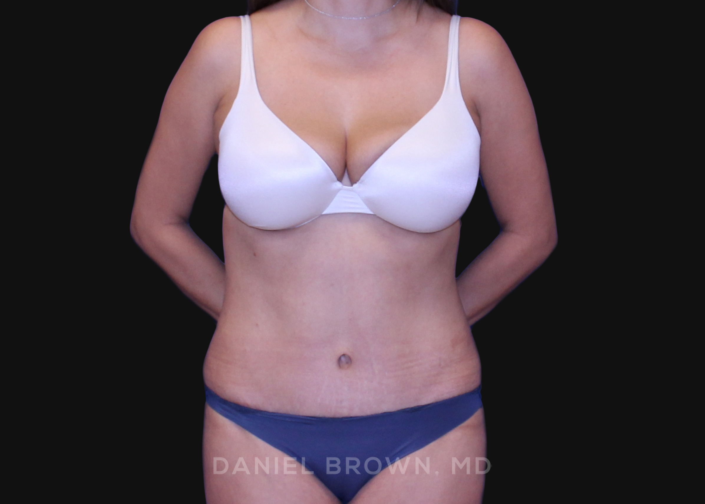 Tummy Tuck Patient Photo - Case 1163 - after view