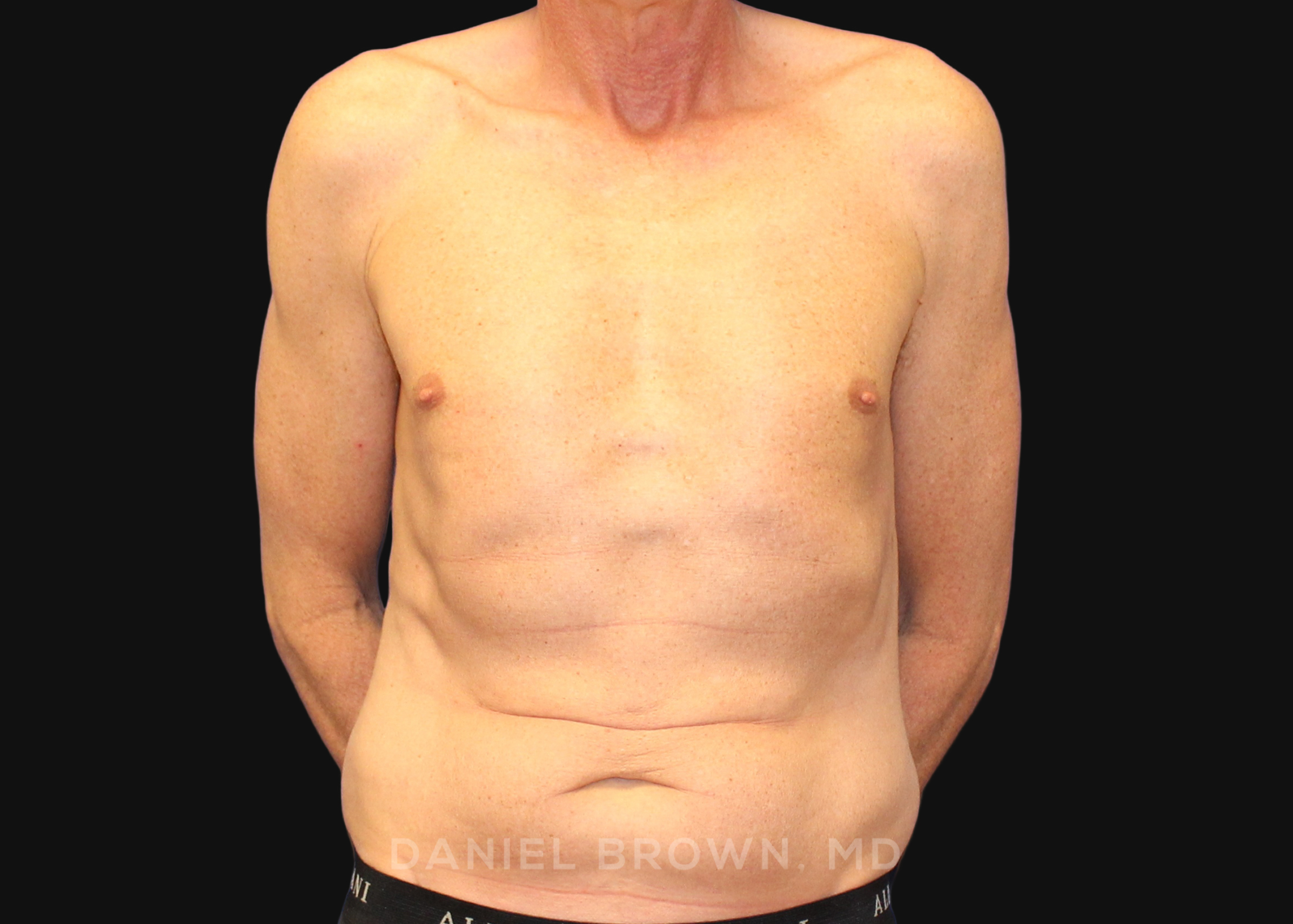 Tummy Tuck Patient Photo - Case 1176 - before view-0
