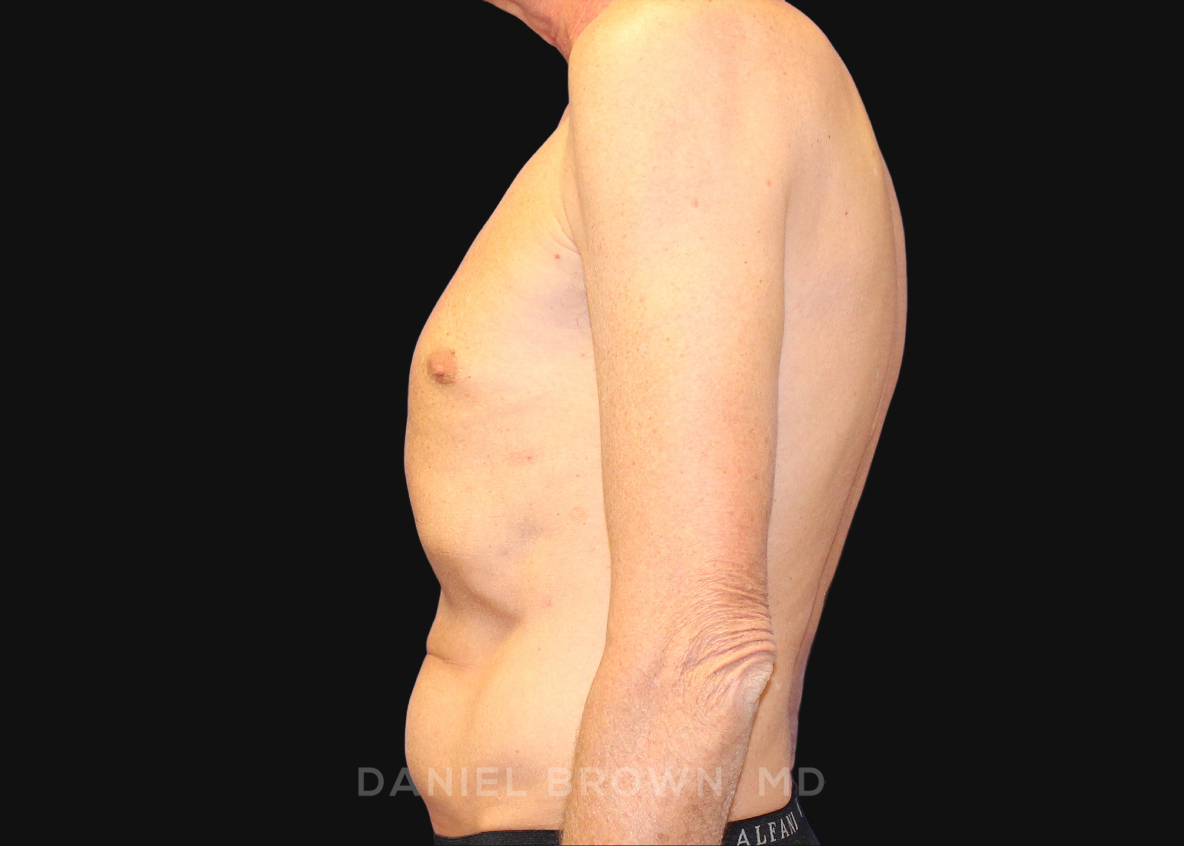 Tummy Tuck Patient Photo - Case 1176 - before view-3