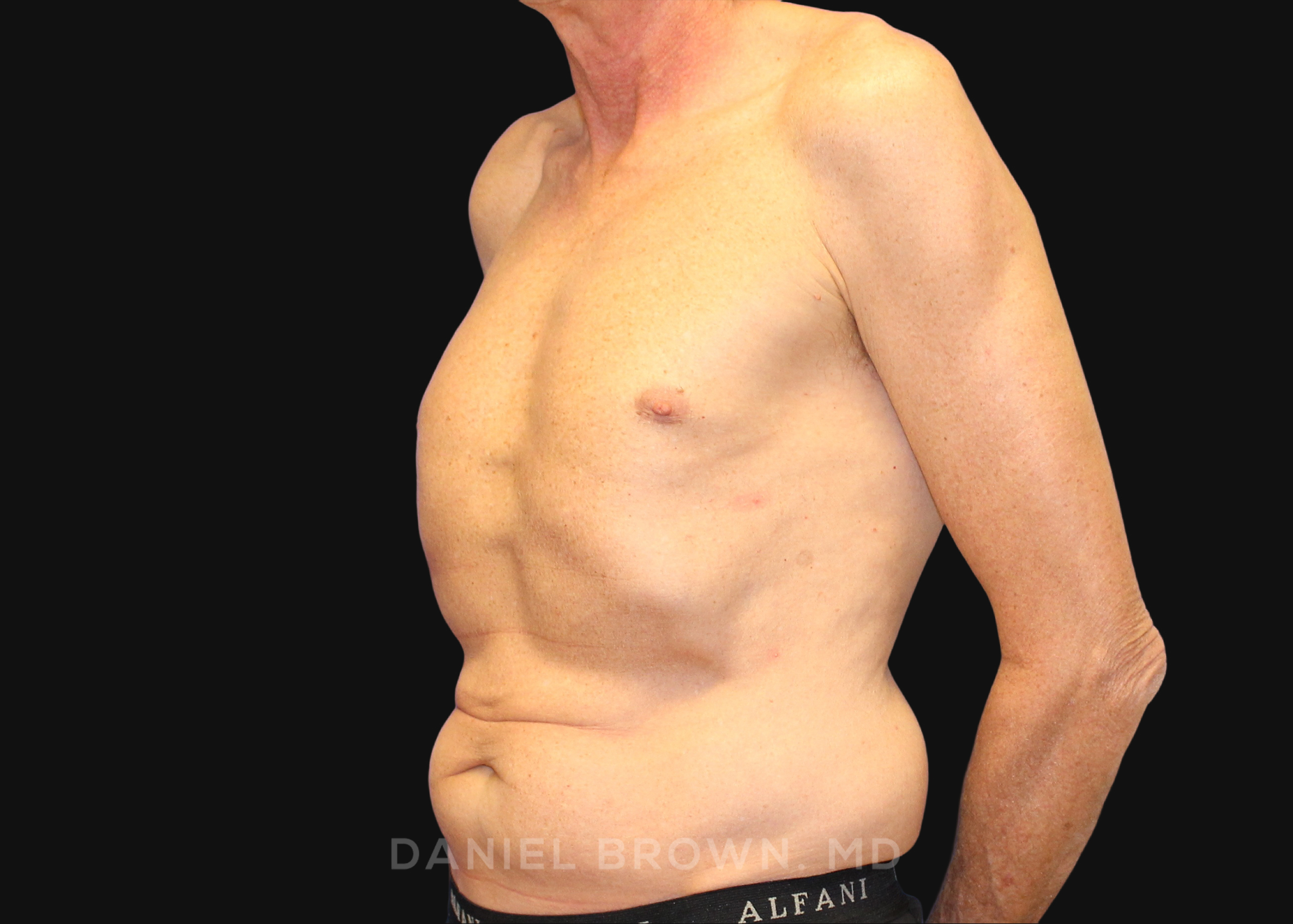Tummy Tuck Patient Photo - Case 1176 - before view-1