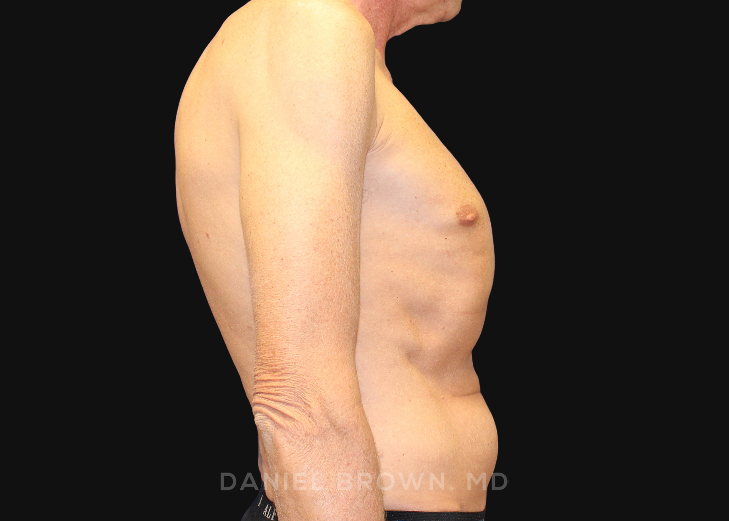Tummy Tuck Patient Photo - Case 1176 - before view-4