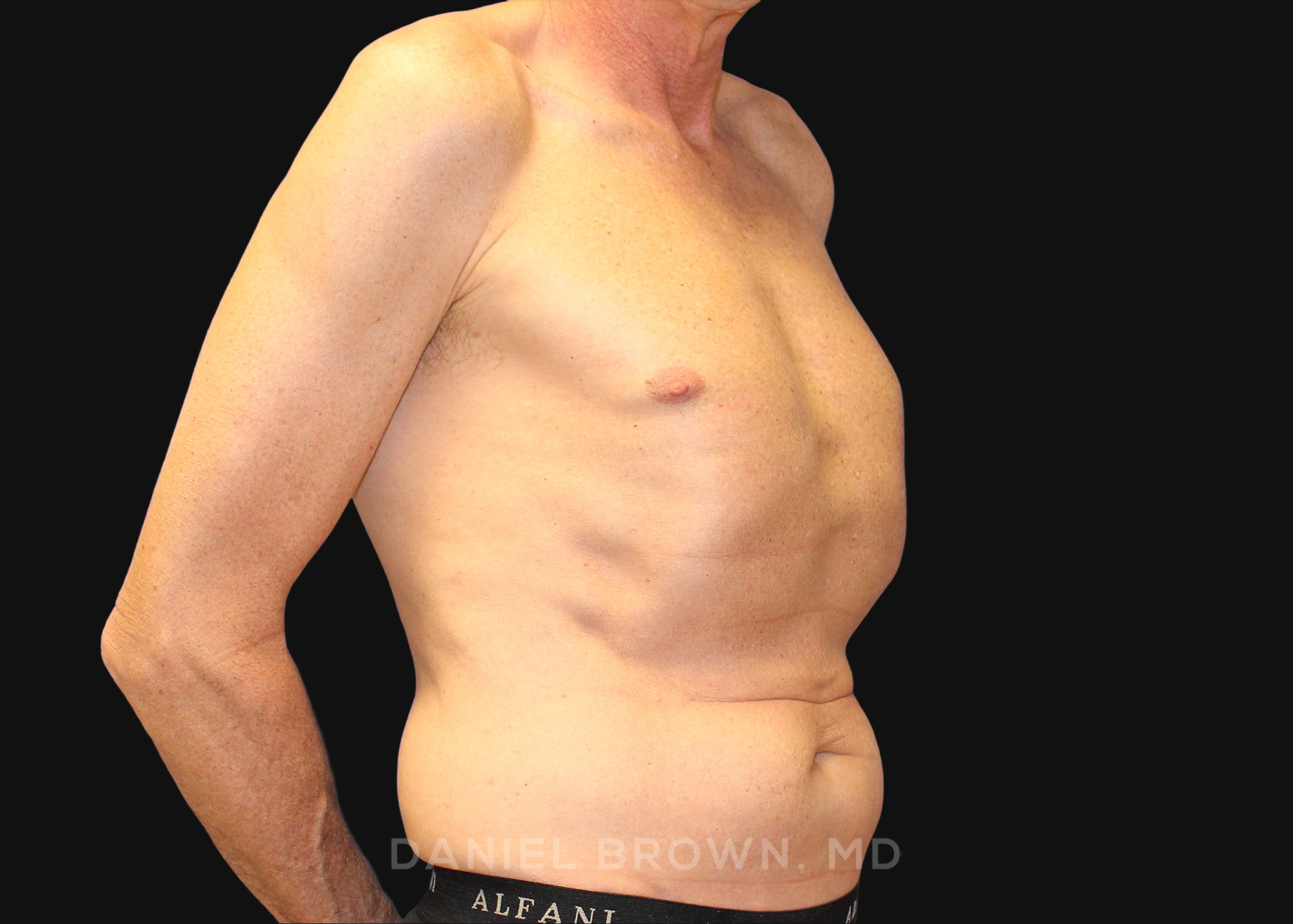 Tummy Tuck Patient Photo - Case 1176 - before view-2