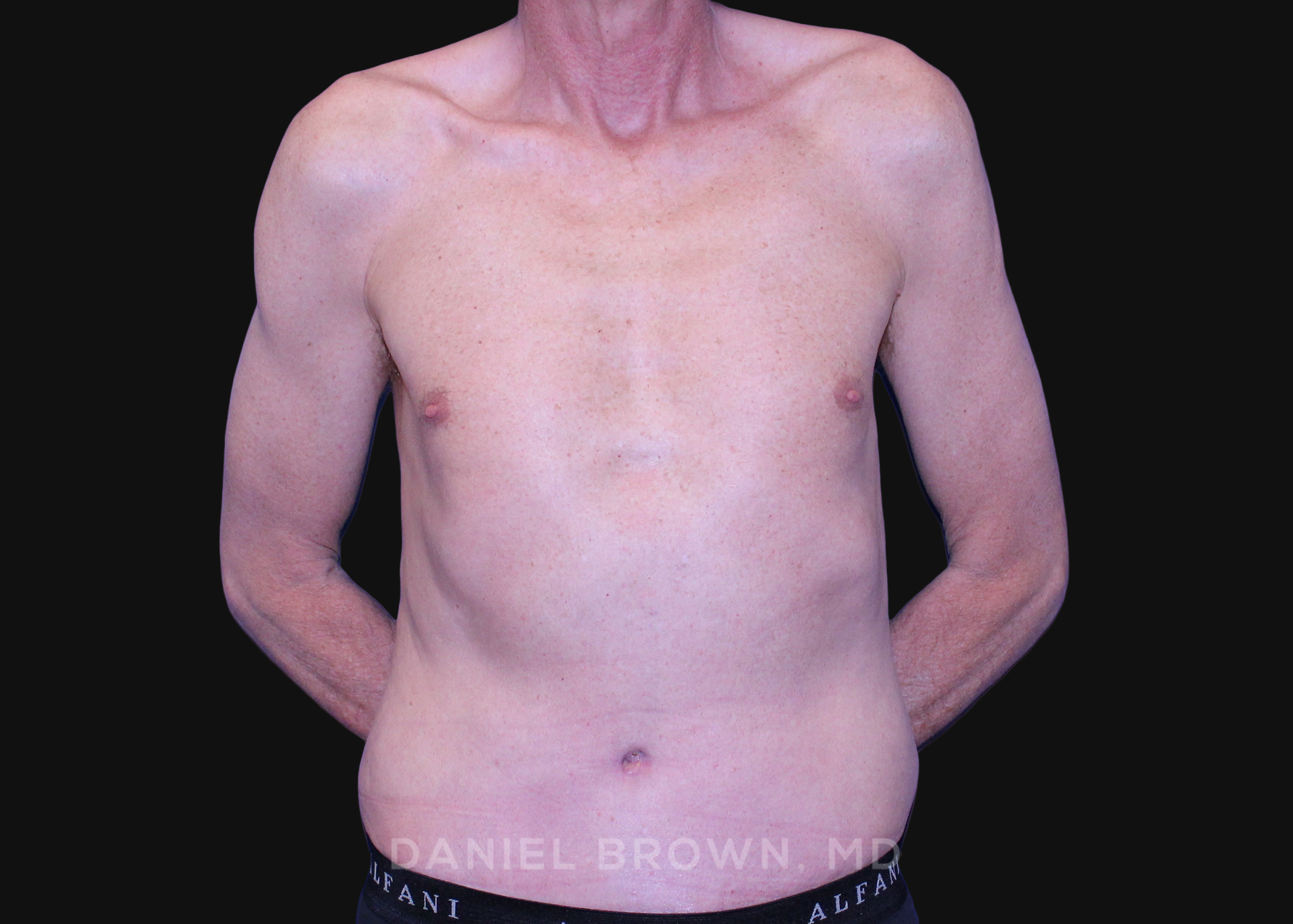 Tummy Tuck Patient Photo - Case 1176 - after view-0