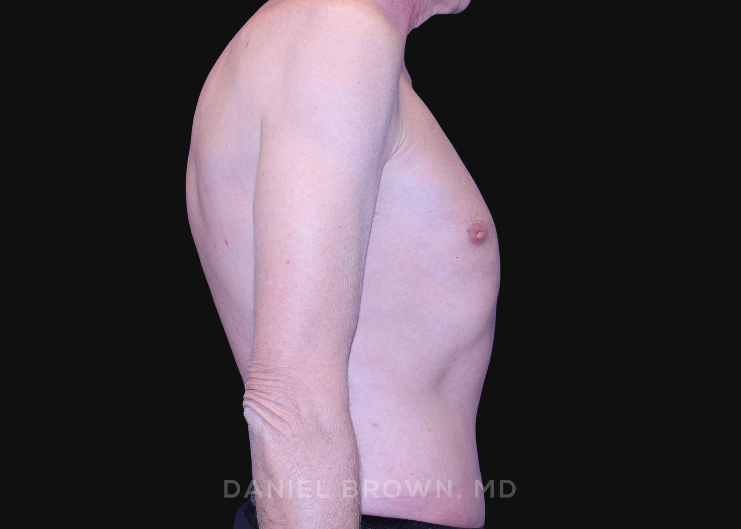 Tummy Tuck Patient Photo - Case 1176 - after view-4