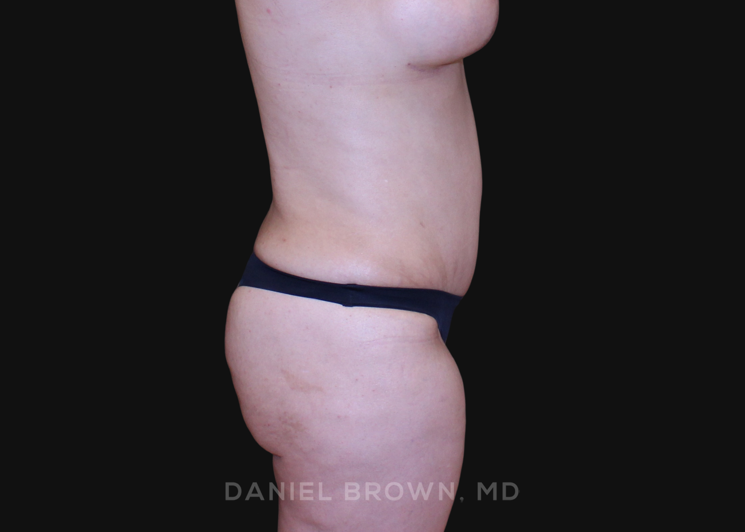 Tummy Tuck Patient Photo - Case 1187 - after view-4