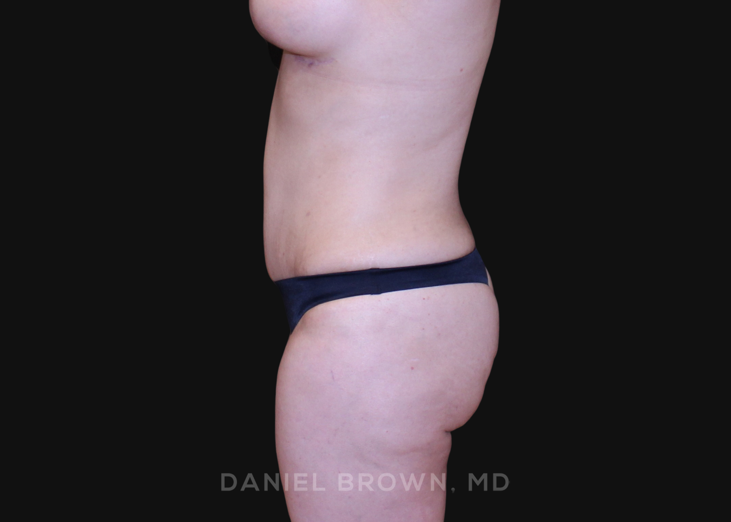 Tummy Tuck Patient Photo - Case 1187 - after view-3