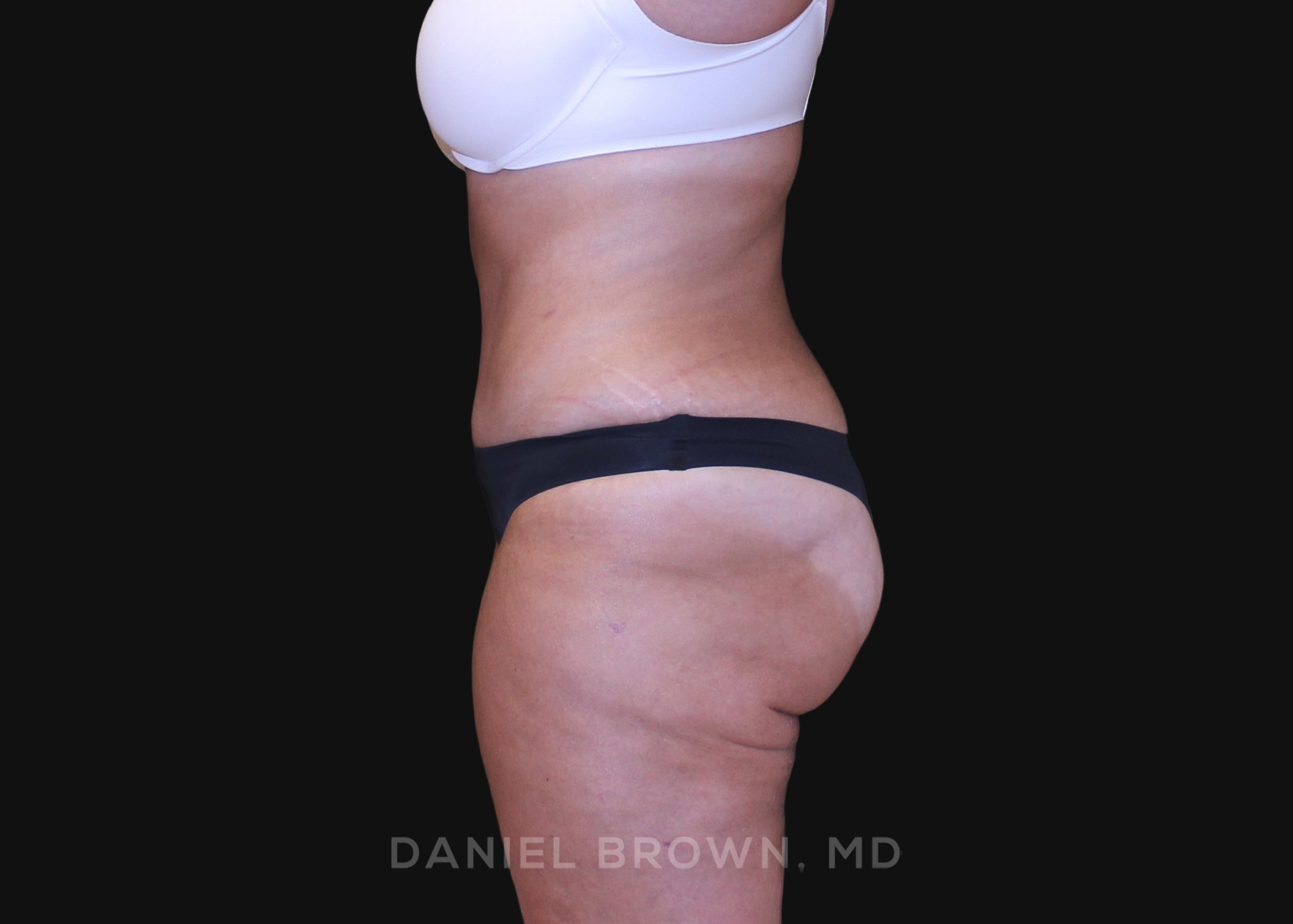 Tummy Tuck Patient Photo - Case 1200 - after view-3