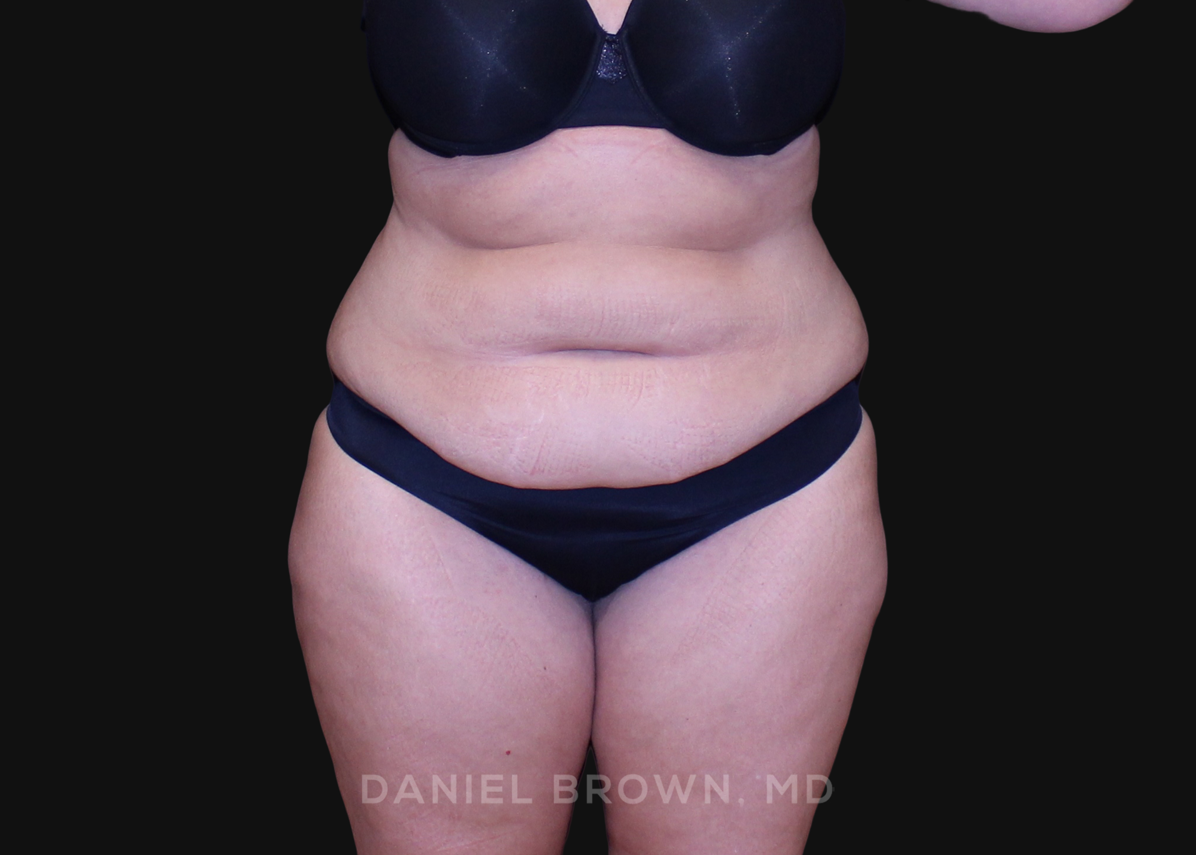 Tummy Tuck Patient Photo - Case 1200 - before view-