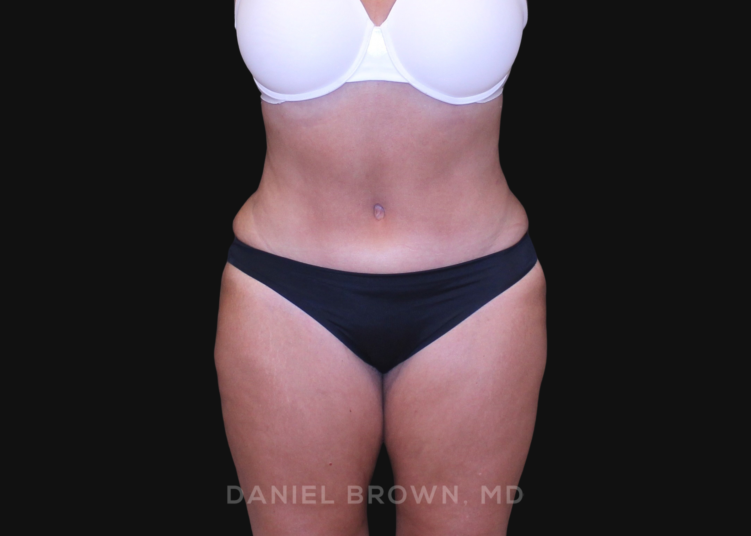 Tummy Tuck Patient Photo - Case 1200 - after view-0