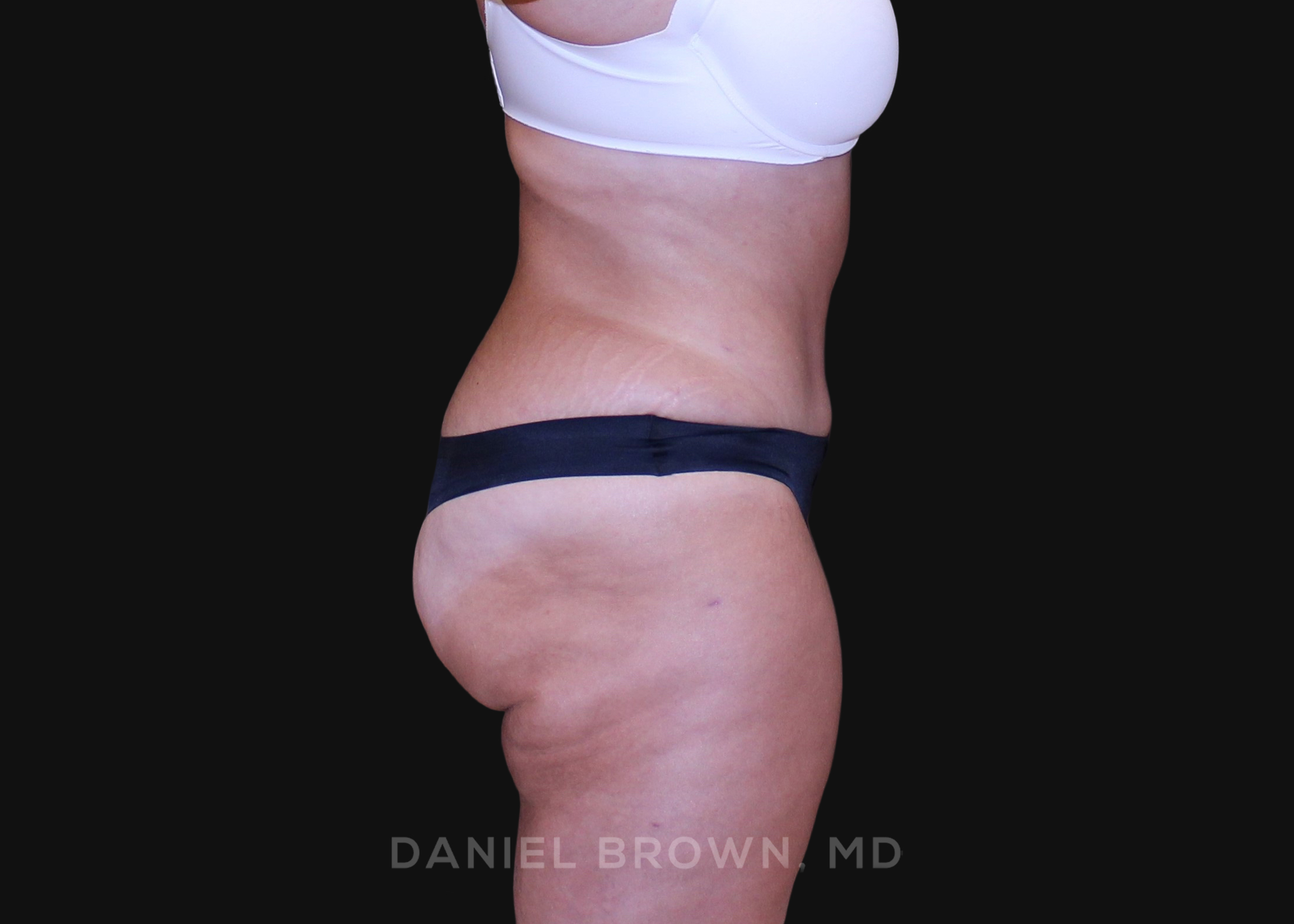 Tummy Tuck Patient Photo - Case 1200 - after view-4