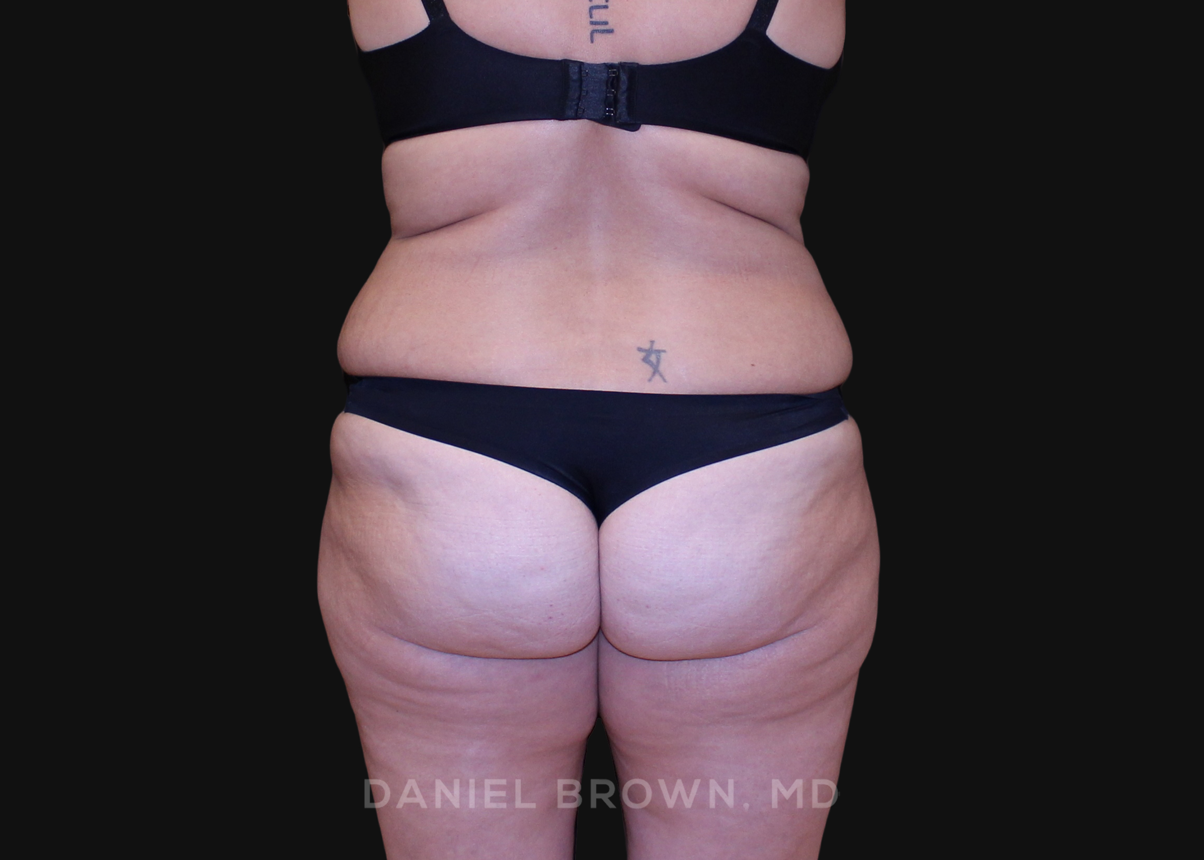 Tummy Tuck Patient Photo - Case 1200 - before view-5