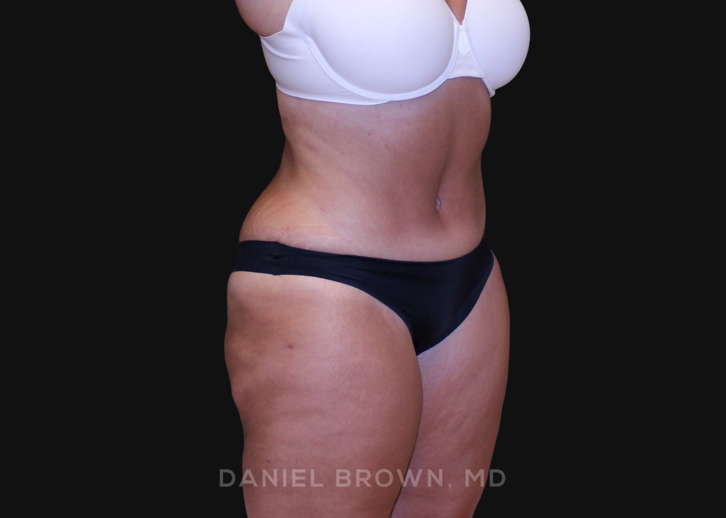 Tummy Tuck Patient Photo - Case 1200 - after view-2