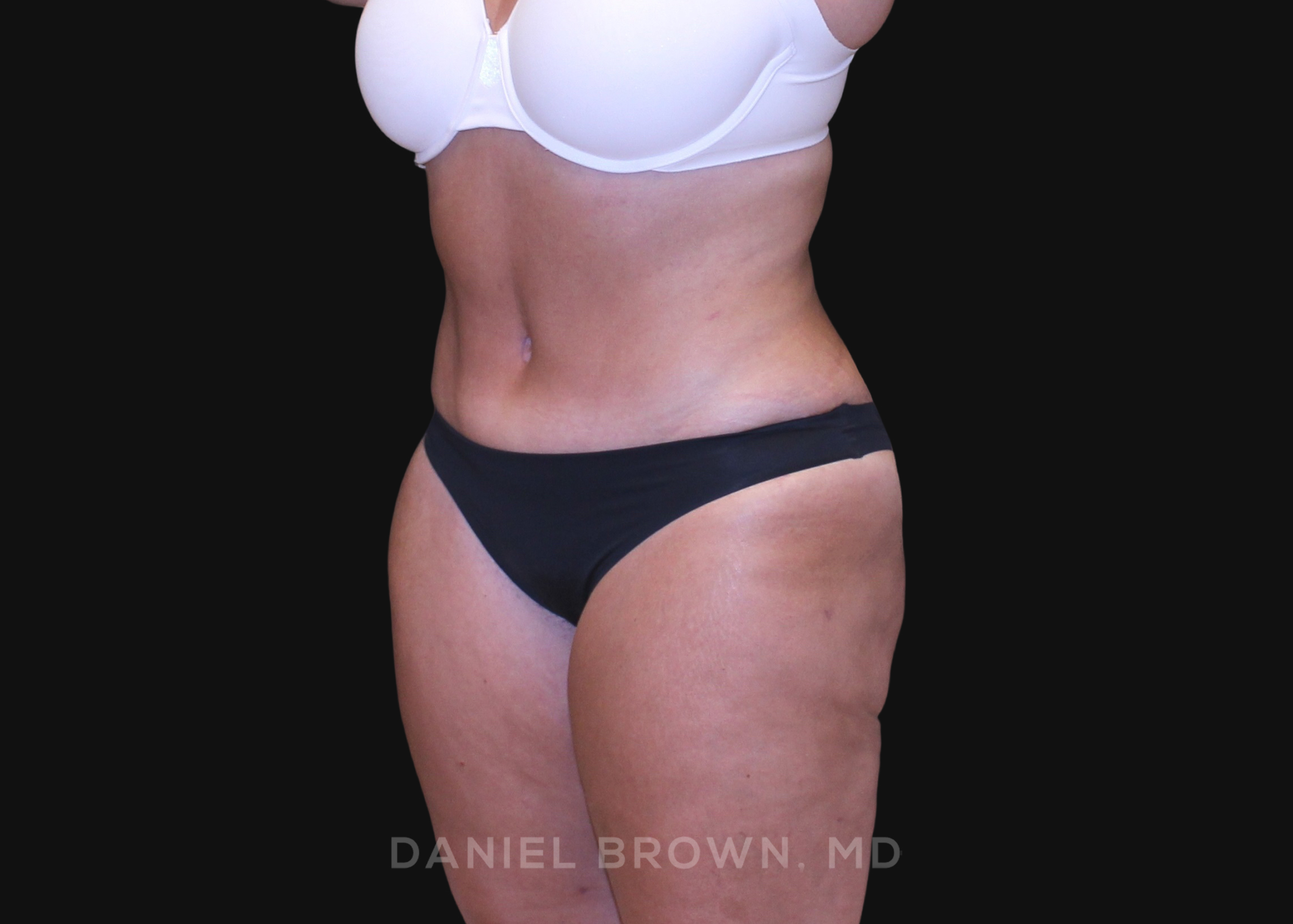 Tummy Tuck Patient Photo - Case 1200 - after view-1