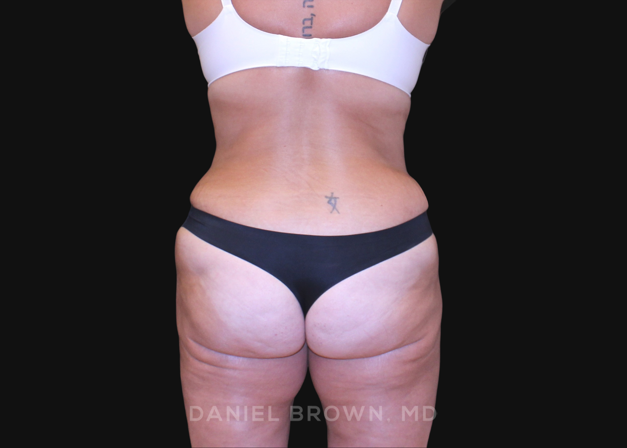 Tummy Tuck Patient Photo - Case 1200 - after view-5