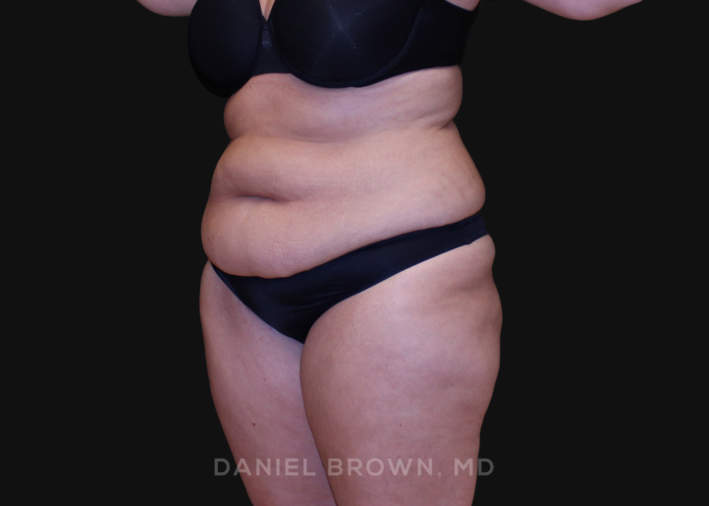 Tummy Tuck Patient Photo - Case 1200 - before view-1