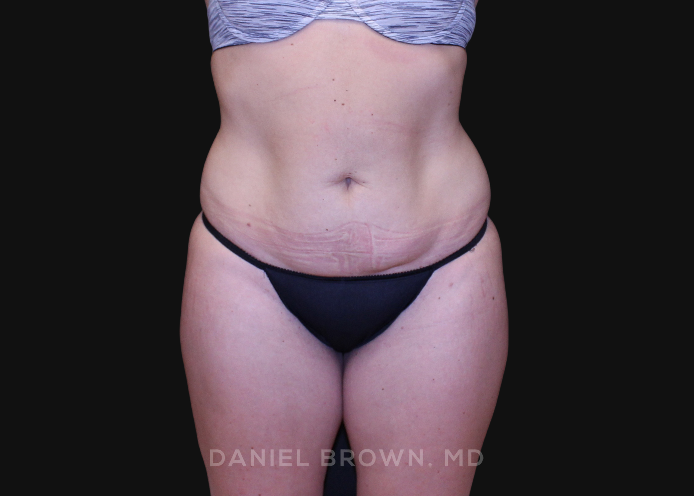 Tummy Tuck Patient Photo - Case 1213 - before view-0