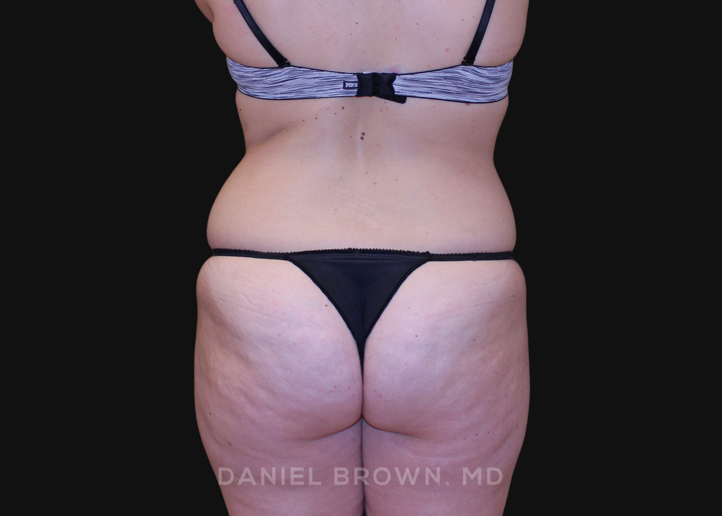 Tummy Tuck Patient Photo - Case 1213 - before view-5
